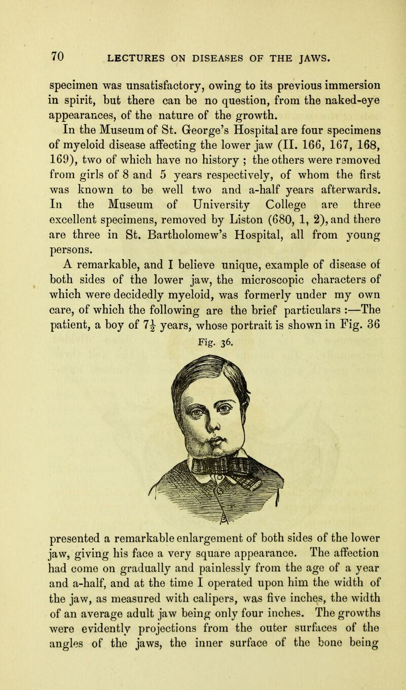 specimen was unsatisfactory, owing to its previous immersion in spirit, but there can be no question, from the naked-eye appearances, of the nature of the growth. In the Museum of St. George's Hospital are four specimens of myeloid disease affecting the lower jaw (II. 166, 167, 168, 169), two of which have no history ; the others were removed from girls of 8 and 5 years respectively, of whom the first was known to be well two and a-half years afterwards. In the Museum of University College are three excellent specimens, removed by Liston (680, 1, 2), and there are three in St. Bartholomew's Hospital, all from young persons. A remarkable, and I believe unique, example of disease of both sides of the lower jaw, the microscopic characters of which were decidedly myeloid, was formerly under my own care, of which the following are the brief particulars :—The patient, a boy of 7 J years, whose portrait is shown in Fig. 36 Fig. 36. presented a remarkable enlargement of both sides of the lower jaw, giving his face a very square appearance. The affection had come on gradually and painlessly from the age of a year and a-half, and at the time I operated upon him the width of the jaw, as measured with calipers, was five inches, the width of an average adult jaw being only four inches. The growths were evidently projections from the outer surfaces of the angles of the jaws, the inner surface of the bone being