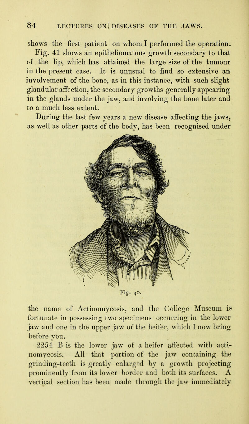 shows the first patient on whom I performed the operation. Fig. 41 shows an epithehomatons growth secondary to that of the lip, which has attained the large size of the tumour in the present case. It is unusual to find so extensive an involvement of the bone, as in this instance, with such slight glandular affection, the secondary growths generally appearing in the glands under the jaw, and involving the bone later and to a much less extent. During the last few years a new disease affecting the jaws, as well as other parts of the body, has been recognised under Fig. 40. the name of Actinomycosis, and the College Museum is fortunate in possessing two specimens occurring in the lower jaw and one in the upper jaw or the heifer, which I now bring before you. 2254 B is the lower jaw of a heifer affected with acti- nomycosis. All that portion of the jaw containing the grinding-teeth is greatly enlarged by a growth projecting prominently from its lower border and both its surfaces. A vertical section has been made through the jaw immediately