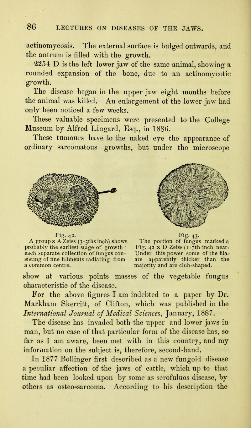 actinomycosis. The external surface is bulged outwards, and the antrum is filled with the growth. 225i D is the left lower jaw of the same animal, showing a rounded expansion of the bone, due to an actinomycotic growth. The disease began in the upper jaw eight months before the animal was killed. An enlargement of the lower jaw had only been noticed a few weeks. These valuable specimens were presented to the College Museum by Alfred Lingard, Esq., in 1880. These tumours have to the naked eye the appearance of ordinary sarcomatous growths, but under the microscope Fig. 42. Fig. 43. A group X A Zeiss (3-5ths inch) shows The portion of fungus marked a probably the earliest stage of growth .• Fig. 42 x D Zeiss (i-jth inch near- each separate collection of fungus con- Under this power some of the fila- sisting of fine filiments radiating from are apparently thicker than the a common centre. majority and are club-shaped. show at various points masses of the vegetable fungus characteristic of the disease. For the above figures I am indebted to a paper by Dr. Markham Skerritt, of Clifton, which was published in the Internatio7ial Journal of Medical Sciences, January, 1887. The disease has invaded both the upper and lower jaws in man, but no case of that particular form of the disease has, so far as I am aware, been met with in this countrv, and my information on the subject is, therefore, second-hand. In 1877 Bollinger first described as a new funooid disease a peculiar affection of the jaws of cattle, which up to that time had been looked upon by some as scrofuluos disease, by others as osteo-sarcoma. According to his description the