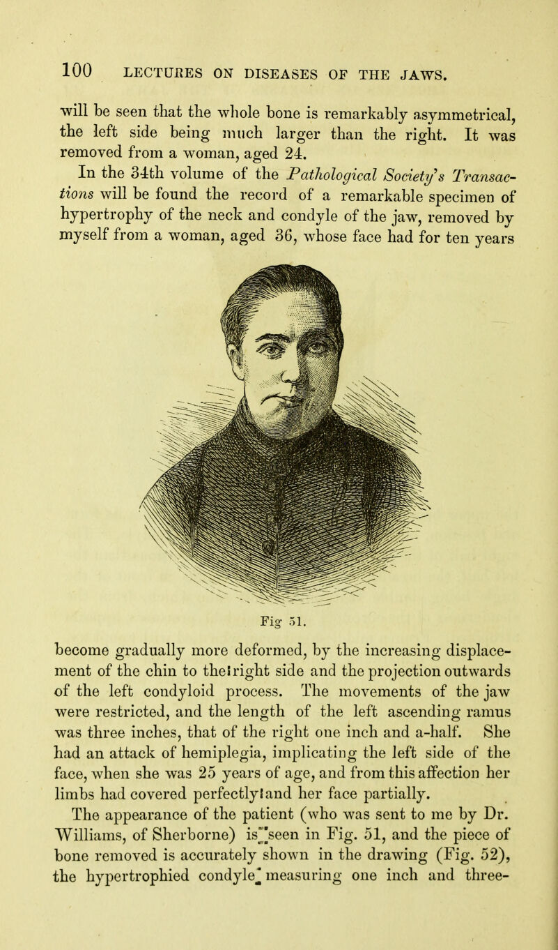 will be seen that the wliole bone is remarkably asymmetrical, the left side being much larger than the right. It was removed from a woman, aged 24. In the 34:th volume of the Pathological Society s Transac- tions will be found the record of a remarkable specimen of hypertrophy of the neck and condyle of the jaw, removed by myself from a woman, aged 36, whose face had for ten years Fig 51. become gradually more deformed, by the increasing displace- ment of the chin to the I right side and the projection outwards of the left condyloid process. The movements of the jaw were restricted, and the length of the left ascending ramus was three inches, that of the right one inch and a-half. She had an attack of hemiplegia, implicating the left side of the face, when she was 25 years of age, and from this affection her limbs had covered perfectly I and her face partially. The appearance of the patient (who was sent to me by Dr. Williams, of Sherborne) is^[seen in Fig. 51, and the piece of bone removed is accurately shown in the drawing (Fig. 52), the hypertrophied condyle^ measuring one inch and three-
