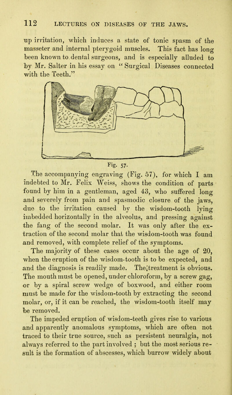 Tip irritation, which induces a state of tonic spasm of the masseter and internal pterygoid muscles. This fact has long been known to dental surgeons, and is especially alluded to hj Mr. Salter in his essay on  Surgical Diseases connected with the Teeth. Fig. 57- The accompanying engraving (Fig. 57), for which I am indebted to Mr. Felix Weiss, shows the condition of parts found by hhn in a gentleman, aged 43, who suffered long and severely from pain and spasmodic closure of the jaws, duo to the irritation caused by the wisdom-tooth lying imbedded horizontally in the alveolus, and pressing against the fang of the second molar. It was only after the ex- traction of the second molar that the wisdom-tooth was found and removed, with complete relief of the symptoms. The majority of these cases occur about the age of 20, when the eruption of the wisdom-tooth is to be expected, and and the diagnosis is readily made. ThOitreatment is obvious. The mouth must be opened, under chloroform, by a screw gag, or by a spiral screw wedge of boxwood, and either room must be made for the wisdom-tooth by extracting the second molar, or, if it can be reached, the wisdom-tooth itself may be removed. The impeded eruption of wisdom-teeth gives rise to various and apparently anomalous symptoms, which are often not traced to their true source, such as persistent neuralgia, not always referred to the part involved ; but the most serious re- sult is the formation of abscesses, which burrow widely about