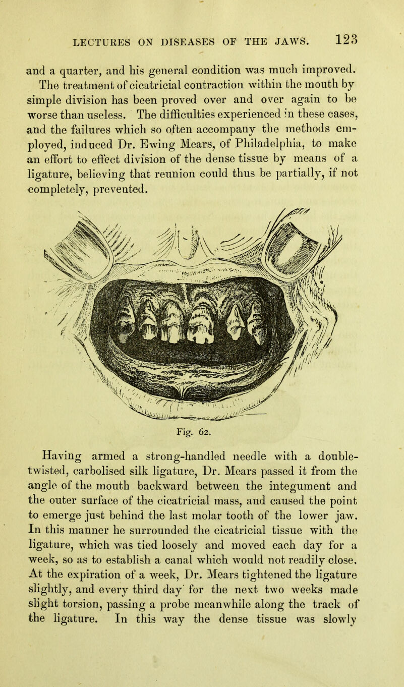 and a quarter, and his general condition was much improved. The treatment of cicatricial contraction within the mouth by simple division has been proved over and over again to be worse than useless. The difficulties experienced in these cases, and the failures which so often accompany the methods em- ployed, induced Dr. Ewing Mears, of Philadelphia, to make an effort to effect division of the dense tissue by means of a ligature, believing that reunion could thus be partially, if not completely, prevented. Fig. 62. Having armed a strong-handled needle with a double- twisted, carbolised silk ligature. Dr. Mears passed it from the angle of the mouth backward between the integument and the outer surface of the cicatricial mass, and caused the point to emerge just behind the last molar tooth of the lower jaw. In this manner he surrounded the cicatricial tissue with the ligature, which was tied loosely and moved each day for a week, so as to establish a canal which would not readily close. At the expiration of a week, Dr. Mears tightened the ligature slightly, and every third day' for the next two weeks made shght torsion, passing a probe meanwhile along the track of the ligature. In this way the dense tissue was slowly