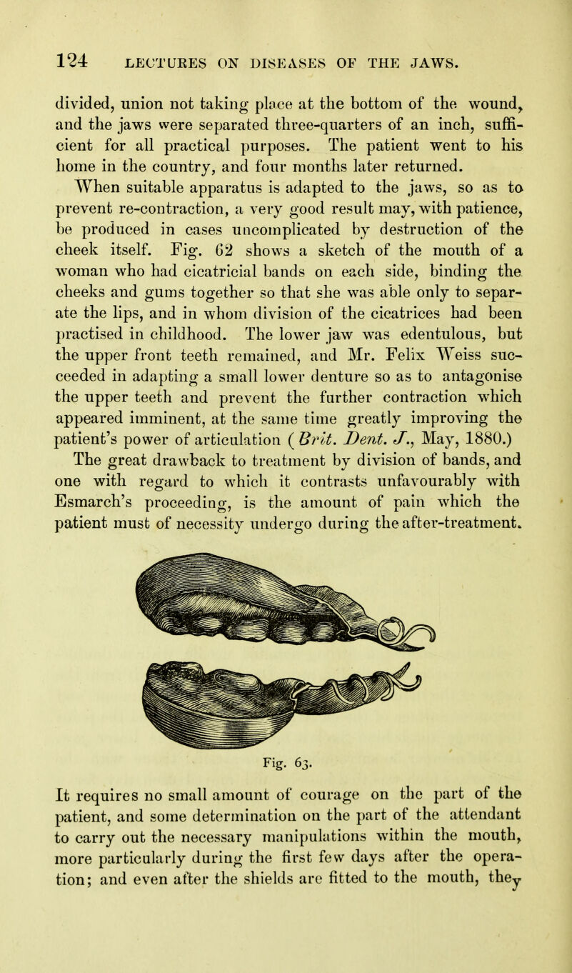 divided, union not taking ploce at the bottom of the wound^ and the jaws were separated three-quarters of an inch, suffi- cient for all practical purposes. The patient went to his home in the country, and four months later returned. When suitable apparatus is adapted to the jaws, so as to prevent re-contraction, a very good result may, with patience, be produced in cases uncomplicated by destruction of the cheek itself. Fig. 62 shows a sketch of the mouth of a woman who had cicatricial bands on each side, binding the cheeks and gums together so that she was able only to separ- ate the lips, and in whom division of the cicatrices had been practised in childhood. The lower jaw was edentulous, but the upper front teeth remained, and Mr. Felix Weiss suc- ceeded in adapting a small lower denture so as to antagonise the upper teeth and prevent the further contraction which appeared imminent, at the same time greatly improving the patient's power of articulation ( Brit. Dent. J., May, 1880.) The great drawback to treatment by division of bands, and one with regard to which it contrasts unfavourably with Esmarch's proceeding, is the amount of pain which the patient must of necessity undergo during the after-treatment. Fig. 63. It requires no small amount of courage on the part of the patient, and some determination on the part of the attendant to carry out the necessary manipulations within the mouth, more particularly during the first few days after the opera- tion; and even after the shields are fitted to the mouth, they