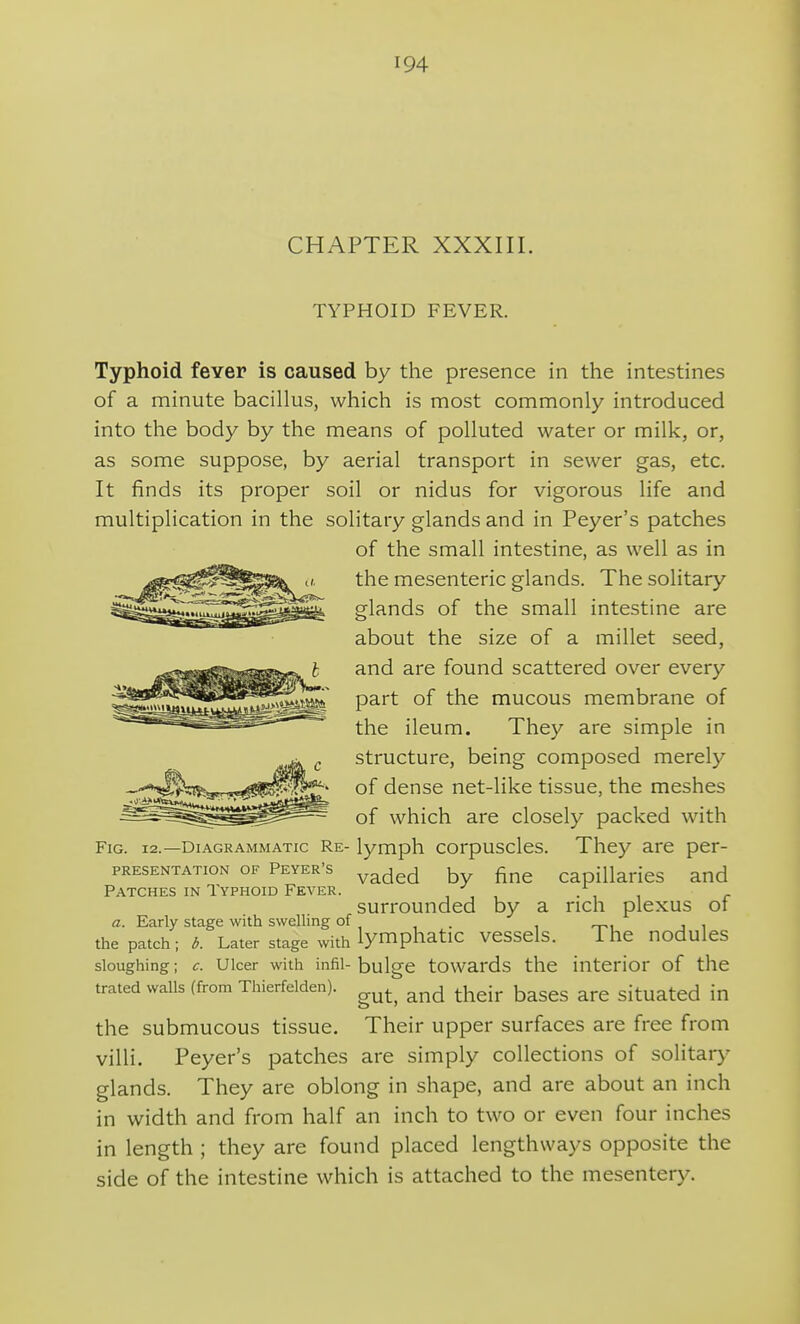 CHAPTER XXXIII. TYPHOID FEVER. Typhoid fever is caused by the presence in the intestines of a minute bacillus, which is most commonly introduced into the body by the means of polluted water or milk, or, as some suppose, by aerial transport in sewer gas, etc. It finds its proper soil or nidus for vigorous life and multiplication in the solitary glands and in Peyer's patches of the small intestine, as well as in the mesenteric glands. The solitary glands of the small intestine are about the size of a millet seed, and are found scattered over every part of the mucous membrane of the ileum. They are simple in structure, being composed merely of dense net-like tissue, the meshes of which are closely packed with Fig. 12.—Diagrammatic Re- lymph corpuscles. They are per- PRESENTATioN OF Peyer's ^^^^^ capillarics and Patches IN Typhoid Fever. , , , ■ , r surrounded by a rich plexus ot a. Early stage with swelling of . the patch; d. Later stage with lymphatic vessels. The nodules sloughing; c. Ulcer with infil-bulge towai'ds the interior of the trated walls (from Thierfelden). . ^^^-^ ^^^^^ situated in the submucous tissue. Their upper surfaces are free from villi. Peyer's patches are simply collections of solitary glands. They are oblong in shape, and are about an inch in width and from half an inch to two or even four inches in length ; they are found placed lengthways opposite the side of the intestine which is attached to the mesentery.