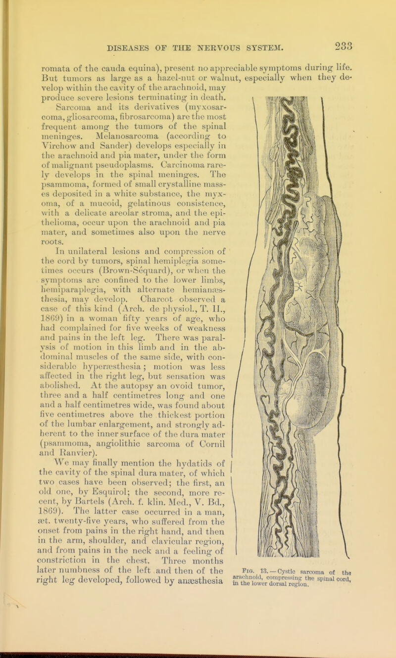 romata of the cauda equina), present no appreciable symptoms during life. But tumors as larg-e as a hazel-nut or walnut, especially when they de- velop within tiie cavity of the araclmoid, may produce severe lesions terminating- in death. Sarcoma and its derivatives (myxosar- coma, gliosarcoma, fibrosarcoma) are the most frequent among the tumors of the spinal meninges. Melanosarcoma (according to Virchow and Sander) develops especially in the arachnoid and pia mater, under the form of malignant pseudoplasms. Carcinoma rare- ly develops in the spinal meninges. The psammoma, formed of small crystalline mass- es deposited in a white substance, the myx- oma, of a mucoid, gelatinous consistence, with a delicate areolar stroma, and tiie epi- thelioma, occur upon the arachnoid and pia mater, and sometimes also upon the nerve roots. In unilateral lesions and compression of the cord by tumors, spinal hemiplegia some- times occurs (Brown-Sequard), or when the symptoms are confined to the lower limbs, hemiparaplegia, w'ith alternate hemiani^is- thesia, may develop. Charcot observed a case of this kind (Arch, do physiol., T. II., 1809) in a woman fifty years of age, who had complained for five weeks of weakness and pains in the left leg. There was paral- ysis of motion in this limb and in the ab- dominal muscles of the same side, with con- siderable hypera\sthesia; motion was less affected in the right leg, but sensation was abolished. At the autopsy an ovoid tumor, three and a half centimetres long and one and a half centimetres wide, was found about five centimetres above the thickest portion of the lumbar enlargement, and strongly ad- herent to the inner surface of the dura mater (psammoma, angiolithic sarcoma of Cornil and Ranvier). We niay finally mention the hydatids of the cavity of the spinal dura mater, of which two cases have been observed; the first, an old one, by Esquirol; the second, more re- cent, by Bartels (Arch. f. klin. Med., V. Bd., 1809). The latter case occurred in a man, iet. twenty-five years, who suffered from the onset from pains in the right hand, and then in the arm, shoulder, and clavicular region, and from pains in the neck and a feeling of constriction in the chest, Tiiree months later numbness of the left and then of the right leg developed, followed by antesthesia Pig. 13.- •Cystic sarcoma of tha arachnoid, compressing the spiual cord in the lower dorsal region. '