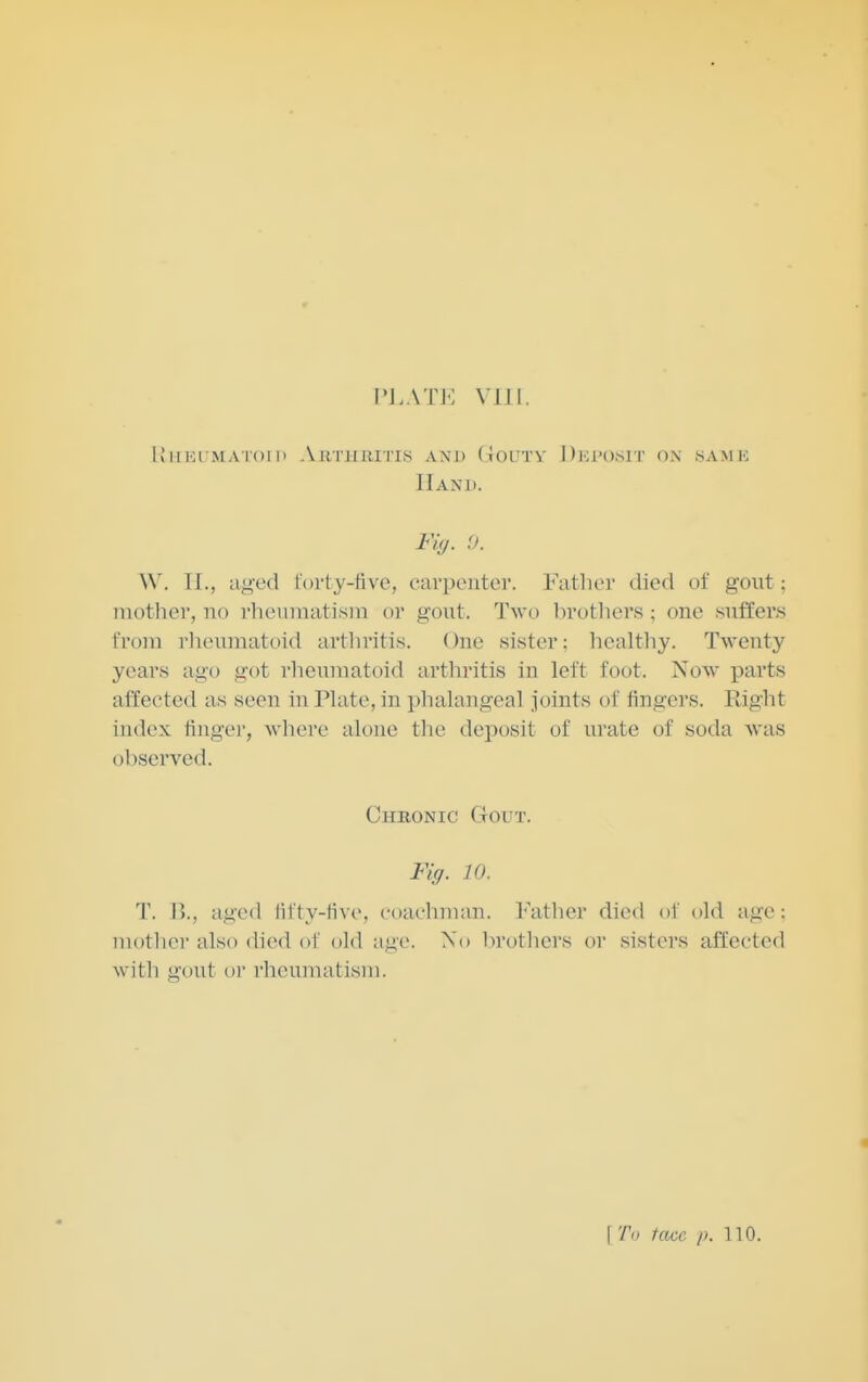 IM.ATK VIII. Hl-IEUMATOl l> AllTIllUTIS AXD ( JOUTV I )i;i'()t>lT OX SAMK Hand. Fiy. U. W. 11., a^-ed t'orty-five, carpenter. Father died of gout; mother, no rhenniatisni or gout. Two brothers ; one suffers from rheumatoid arthritis. One sister; healthy. Twenty years ago got rheumatoid arthritis in left foot. Now parts affected as seen in Plate, in phalangeal joints of fingers. Right index linger, where alone tlie deposit of urate of soda was observed. Chronic Gout. Fig. 10. T. B., aged lil ty-tive, coachman. Father died of old age; luotlier also died of old age. No In'others or sisters affected with gout or rheumatism. I Ti< face [). no.
