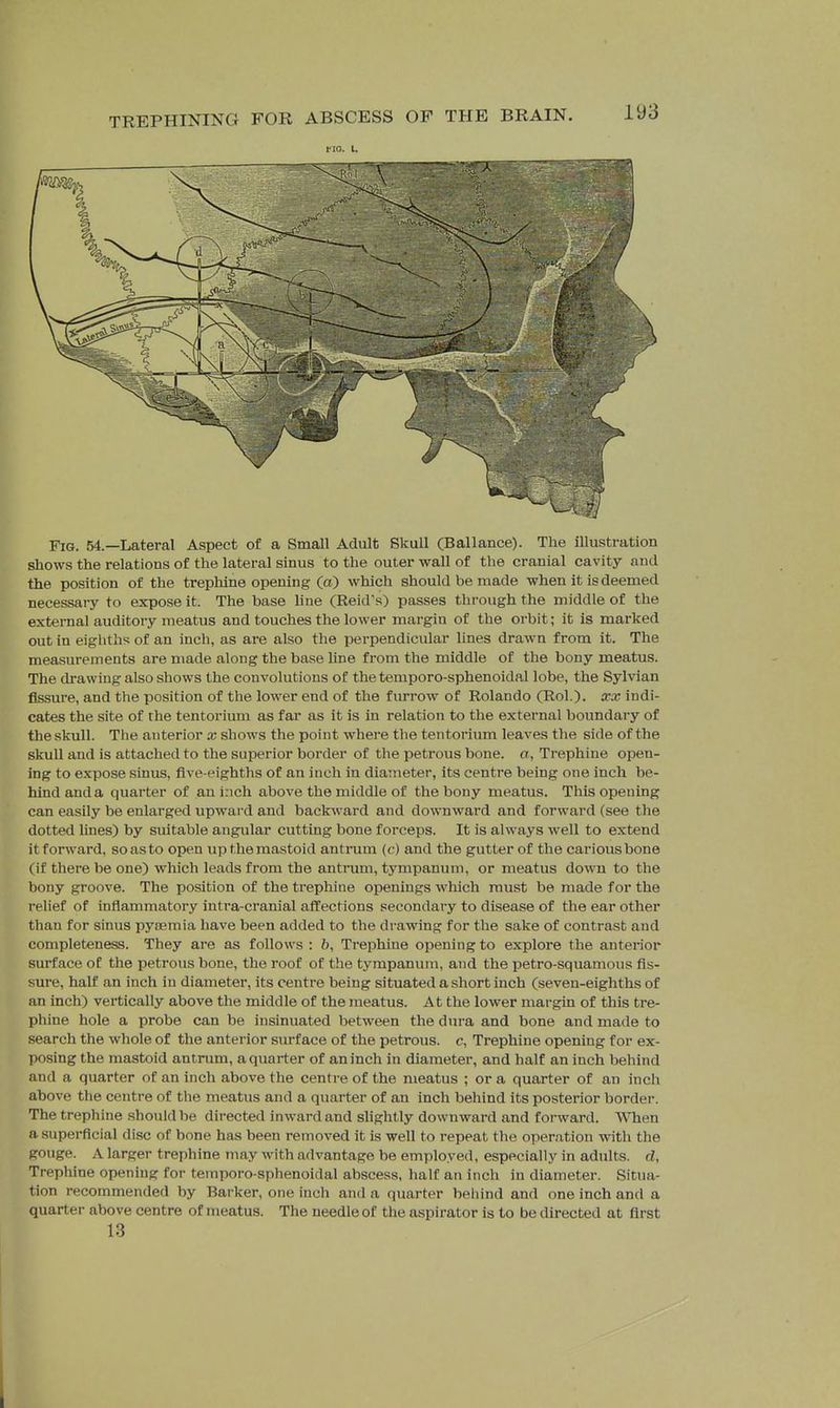 no. I. Fig. 54.—Lateral Aspect of a Small Adult Skull (Ballance). The illustration shows the relations of the lateral sinus to the outer wall of the cranial cavity and the position of the trephine opening (a) which should be made when it is deemed necessai-y to expose it. The base line (Reid's) passes through the middle of the external auditory meatus and touches the lower margin of the orbit; it is marked out in eigliths of an inch, as are also the perpendicular lines drawn from it. The measurements are made along the base hne from the middle of the bony meatus. The drawing also shows the convolutions of the temporo-sphenoidal lobe, the Sylvian fissure, and the position of the lower end of the furrow of Rolando (Rol.). xx indi- cates the site of the tentorium as far as it is in relation to the external boundary of the skull. The anterior x shows the point where the tentorium leaves the side of the skull and is attached to the superior border of the petrous bone, a, Trephine open- ing to expose sinus, five-eighths of an inch in diameter, its centre being one inch be- hind and a quarter of an inch above the middle of the bony meatus. This opening can easily be enlarged upward and backward and downward and forward (see the dotted lines) by suitable angular cutting bone forceps. It is always well to extend it forward, so as to open up the mastoid antrum (c) and the gutter of the carious bone (if there be one) which leads from the antrum, tympanum, or meatus down to the bony groove. The position of the trephine openings which must be made for the relief of inflammatory intra-cranial affections secondary to disease of the ear other than for sinus pyoemia have been added to the drawing for the sake of contrast and completeness. They are as follows : ft. Trephine opening to explore the anterior surface of the petrous bone, the roof of the tympanum, and the petro-squamous fis- sure, half an inch in diameter, its centre being situated a short inch (seven-eighths of an inch) vertically above the middle of the meatus. At the lower margin of this tre- phine hole a probe can be insinuated between the dm-a and bone and made to search the whole of the anterior surface of the petrous, c, Trephine opening for ex- posing the mastoid antrum, a quarter of an inch in diameter, and half an inch behind and a quarter of an inch above the centre of the meatus ; or a quarter of an inch above the centre of the meatus and a quarter of an inch behind its posterior border. The trephine .should be directed inward and slightly downward and forward. When a superficial disc of bone has been removed it is well to repeat the operation with the gouge. A larger trephine may with advantage be employed, especially in adults, d. Trephine opening for temporo-sphenoidal abscess, half an inch in diameter. Situa- tion recommended by Barker, one inch and a quarter behind and one inch and a quarter above centre of meatus. The needle of the aspirator is to be directed at first 13
