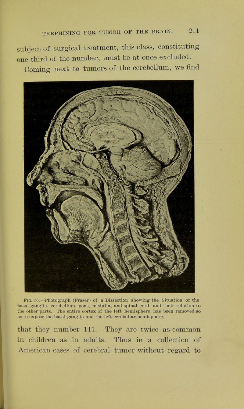 subject of surgical treatment, this class, constituting one-third of the number, must be at once excluded. Coming next to tumors of the cerebellum, we find Fig. 5G.—Photograph (Fraser) of a Dissection showing the Situation ot the basal ganglia, cerebellum, pons, medulla, and spinal cord, and their relation to the other parts. The entire cortex of the left hemisphere has been removed so as to expose the basal ganglia and the left cerebellar hemisphere. that they number 141. They are twice as common in children as in adults. Thus in a collection of American cases of cerebral tumor without regard to