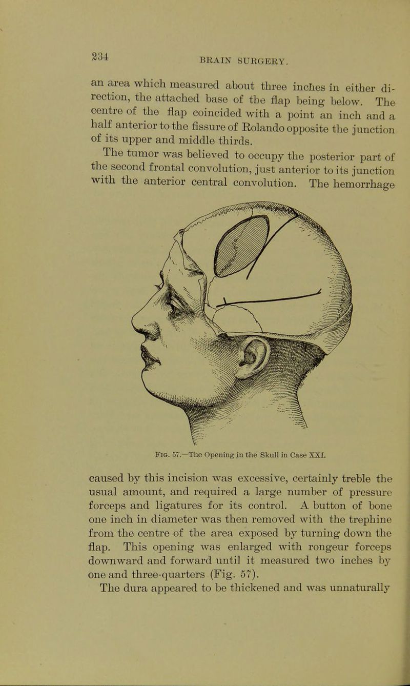 an area which measured about three inches in either di- rection, the attached base of the flap being below. The centre of the flap coincided with a point an inch and a half anterior to the fissure of Rolando opposite the junction of its upper and middle thirds. The tumor was believed to occupy the posterior part of the second frontal convolution, just anterior to its junction with the anterior central convolution. The hemorrhage Fig. 57.—The Opening }n the Skull in Case XXI. caused by this incision was excessive, certainly treble the usual amount, and required a large number of pressure forceps and ligatures for its control. A button of bone one inch in diameter was then removed with the trephine from the centre of the area exposed by turning down the flap. This opening was enlarged with rongeur forceps downward and forward until it measured two inches by one and three-quarters (Fig. 57). The dura appeared to be thickened and was unnaturally