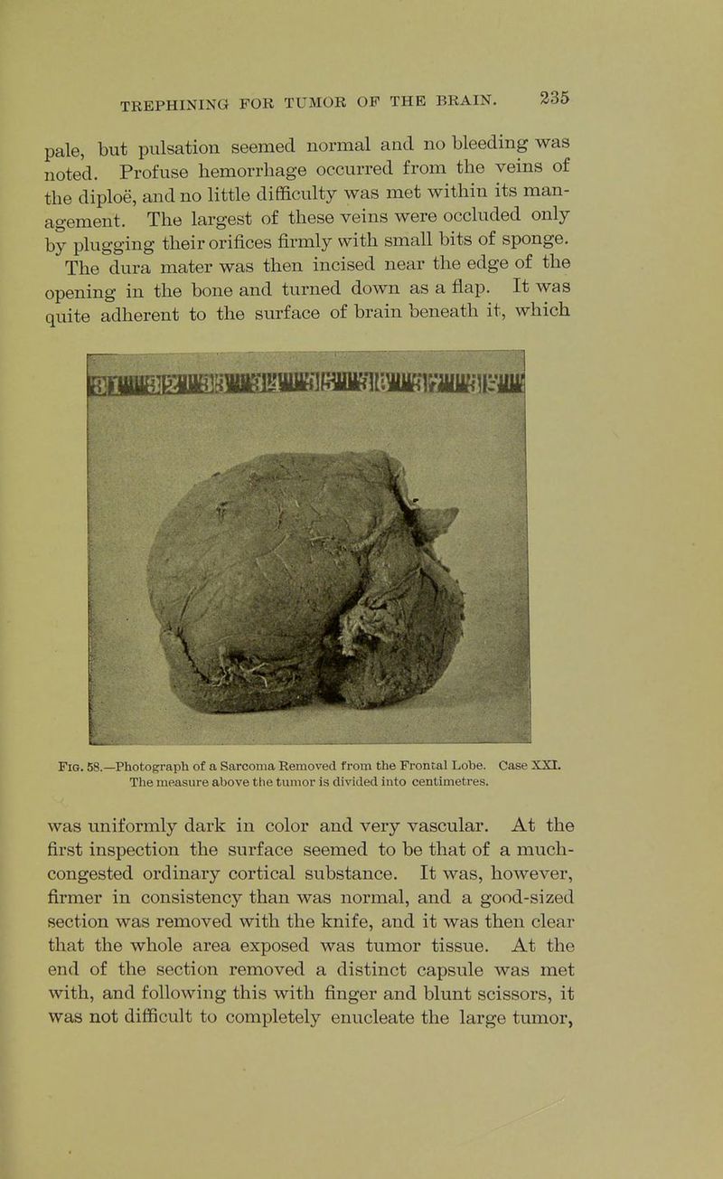 pale, but pulsation seemed normal and no bleeding was noted. Profuse hemorrhage occurred from the veins of the diploe, and no little difficulty was met within its man- agement. The largest of these veins were occluded only by plugging their orifices firmly with small bits of sponge. The dura mater was then incised near the edge of the opening in the bone and turned down as a flap. It was quite adherent to the surface of brain beneath it, which Fig. 58.—Photograph of a Sarcoma Removed from the Frontal Lobe. Case XXI. The measure above the tumor is divided into centimetres. was uniformly dark in color and very vascular. At the first inspection the surface seemed to be that of a much- congested ordinary cortical substance. It was, however, firmer in consistency than was normal, and a good-sized section was removed with the knife, and it was then clear that the whole area exposed was tumor tissue. At the end of the section removed a distinct capsule was met with, and following this with finger and blunt scissors, it was not difficult to completely enucleate the large tumor,