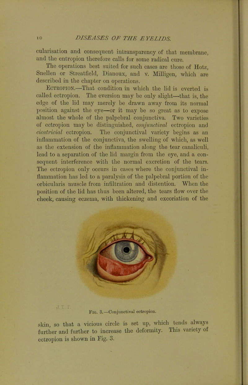 cularisation and consequent intransparency of that membrane, and the entropion therefore calls for some radical cure. The operations best suited for such cases are those of Hotz, Snellen or Streatfield, Dianoux, and v. Milligen, which are described in the chapter on operations. Ectropion.—That condition in which the lid is everted is called ectropion. The eversion may be only slight—that is, the edge of the lid may merely be drawn away from its normal position against the eye—or it may be so great as to expose almost the whole of the palpebral conjunctiva. Two varieties of ectropion may be distinguished, conjunctival ectropion and cicatricial ectropion. The conjunctival variety begins as an inflammation of the conjunctiva, the swelling of which, as well as the extension of the inflammation along the tear canaliculi, lead to a separation of the lid margin from the eye, and a con- sequent interference with the normal excretion of the tears. The ectropion only occurs in cases where the conjunctival in- flammation has led to a paralysis of the palpebral portion of the orbicularis muscle from infiltration and distention. When the position of the lid has thus been altered, the tears flow over the cheek, causing eczema, with thickening and excoriation of the Fig. 3.—Conjunctival ectropion. skin, so that a vicious circle is set up, which tends always further and further to increase the deformity. This variety of ectropion is shown in Fig. 3.