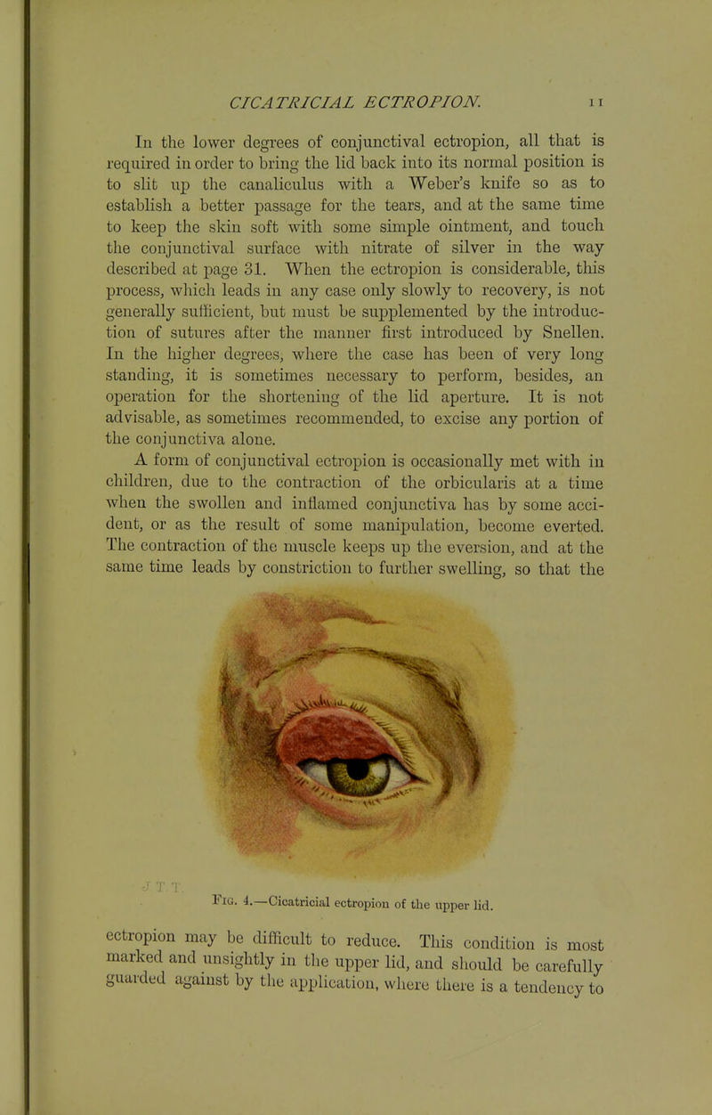 CICATRICIAL ECTROPION. In the lower degrees of conjunctival ectropion, all that is required in order to bring the lid back into its normal position is to slit up the canaliculus with a Weber's knife so as to establish a better passage for the tears, and at the same time to keep the skin soft with some simple ointment, and touch the conjunctival surface with nitrate of silver in the way described at page 31. When the ectropion is considerable, this process, which leads in any case only slowly to recovery, is not generally sufficient, but must be supplemented by the introduc- tion of sutures after the manner first introduced by Snellen. In the higher degrees, where the case has been of very long standing, it is sometimes necessary to perform, besides, an operation for the shortening of the lid aperture. It is not advisable, as sometimes recommended, to excise any portion of the conjunctiva alone, A form of conjunctival ectropion is occasionally met with in children, due to the contraction of the orbicularis at a time when the swollen and inflamed conjunctiva has by some acci- dent, or as the result of some manipulation, become everted. The contraction of the muscle keeps up the eversion, and at the same time leads by constriction to further swelling, so that the J- T. T. Tig. 4.—Cicatricial ectropion of the upper lid. ectropion may be difficult to reduce. This condition is most marked and unsightly in the upper lid, and should be carefully guarded against by the application, where there is a tendency to