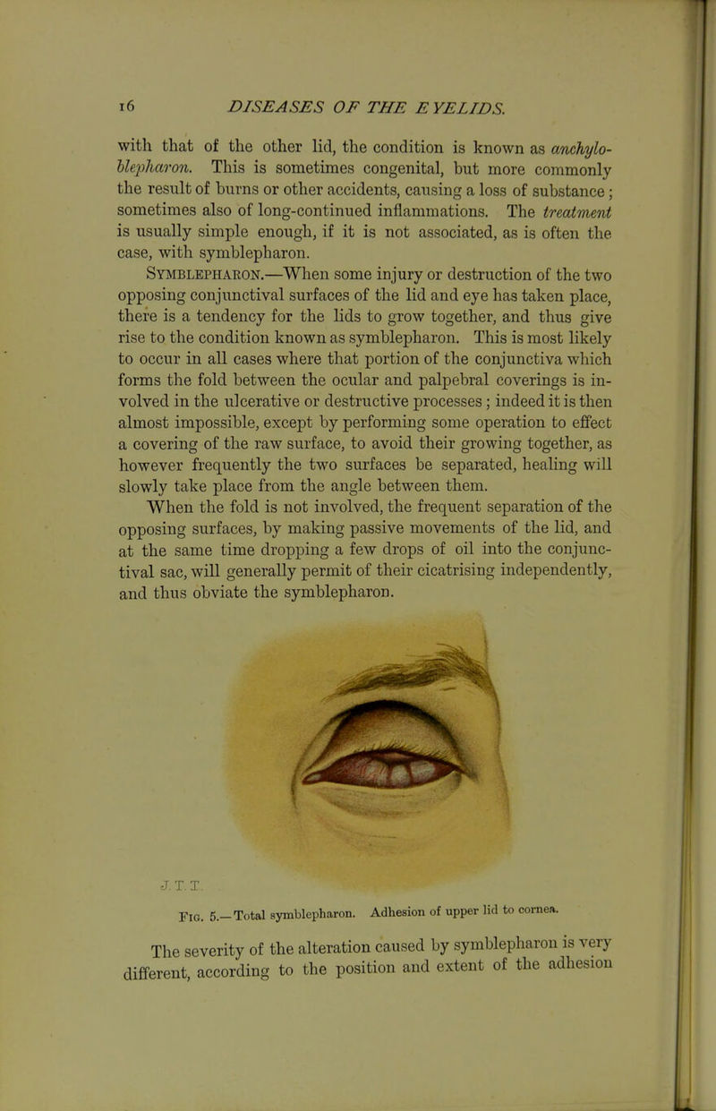 with that of the other lid, the condition is known as anchylo- Uepharon. This is sometimes congenital, but more commonly the result of burns or other accidents, causing a loss of substance ; sometimes also of long-continued inflammations. The treatment is usually simple enough, if it is not associated, as is often the case, with symblepharon. Symblepharon.—When some injury or destruction of the two opposing conjunctival surfaces of the lid and eye has taken place, there is a tendency for the lids to grow together, and thus give rise to the condition known as symblepharon. This is most likely to occur in all cases where that portion of the conjunctiva wliich forms the fold between the ocular and palpebral coverings is in- volved in the ulcerative or destructive processes ; indeed it is then almost impossible, except by performing some operation to effect a covering of the raw surface, to avoid their growing together, as however frequently the two surfaces be separated, healing will slowly take place from the angle between them. When the fold is not involved, the frequent separation of the opposing surfaces, by making passive movements of the lid, and at the same time dropping a few drops of oil into the conjunc- tival sac, will generally permit of their cicatrising independently, and thus obviate the symblepharon. J. T. T. . Fig. 5.-Total symblepharon. Adhesion of upper lid to cornea. The severity of the alteration caused by symblepharon is very different, according to the position and extent of the adhesion