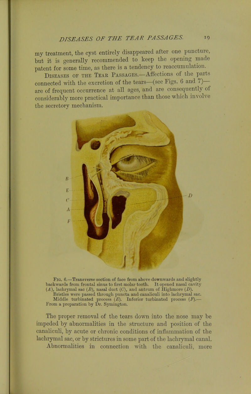 my treatment, the cyst entirely disappeared after one puncture, but it is generally recommended to keep the opening made patent for some time, as there is a tendency to reaccumulation. Diseases of the Tear Passages.—Affections of the parts connected with the excretion of the tears—(see Figs. 6 and 7)— are of frequent occurrence at all ages, and are consequently of considerably more practical importance than those which involve the secretory mechanism. Fig. 6.—Transverse section of face from above downwards and slightly backwards from frontal sinus to first molar tooth. It opened nasal cavitj' {A), lachrymal sac {B), nasal duct {C), and antrum of Highmore {D). Bristles were passed through puncta and canaliculi into lachrymal sac. Middle turbinated process {E). Inferior turbinated process [P).— From a preparation by Dr. SjTuington. The proper removal of the tears down into the nose may be impeded by abnormalities in the structure and position of the canaliculi, by acute or chronic conditions of inflammation of the lachrymal sac, or by strictures in some part of the lachrymal canal. Abnormalities in connection with the canaliculi, more