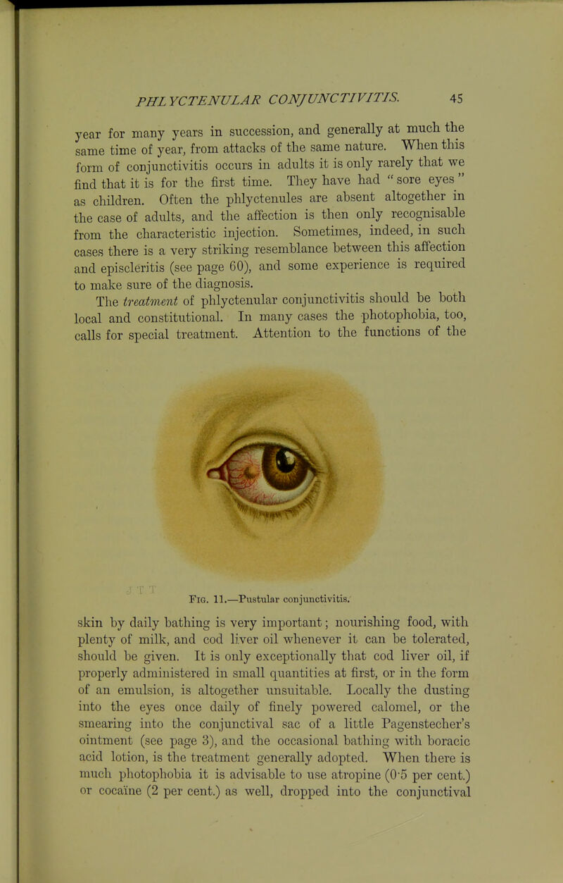 year for many years in succession, and generally at much the same time of year, from attacks of the same nature. When this form of conjunctivitis occurs in adults it is only rarely that we find that it is for the first time. They have had sore eyes  as children. Often the phlyctenules are absent altogether in the case of adults, and the affection is then only recognisable from the characteristic injection. Sometimes, indeed, in such cases there is a very striking resemblance between this affection and episcleritis (see page 60), and some experience is required to make sure of the diagnosis. The treatment of phlyctenular conjunctivitis should be both local and constitutional. In many cases the photophobia, too, calls for special treatment. Attention to the functions of the Fig. 11.—Pustular conjunctivitis. skin by daily bathing is very important; nourishing food, with plenty of milk, and cod liver oil whenever it can be tolerated, should be given. It is only exceptionally that cod liver oil, if properly administered in small quantities at first, or in the form of an emulsion, is altogether unsuitable. Locally the dusting into the eyes once daily of finely powered calomel, or the smearing into the conjunctival sac of a little Pagenstecher's ointment (see page 3), and the occasional bathing with boracic acid lotion, is the treatment generally adopted. When there is much photophobia it is advisable to use atropine (0'5 per cent.) or cocaine (2 per cent.) as well, dropped into the conjunctival