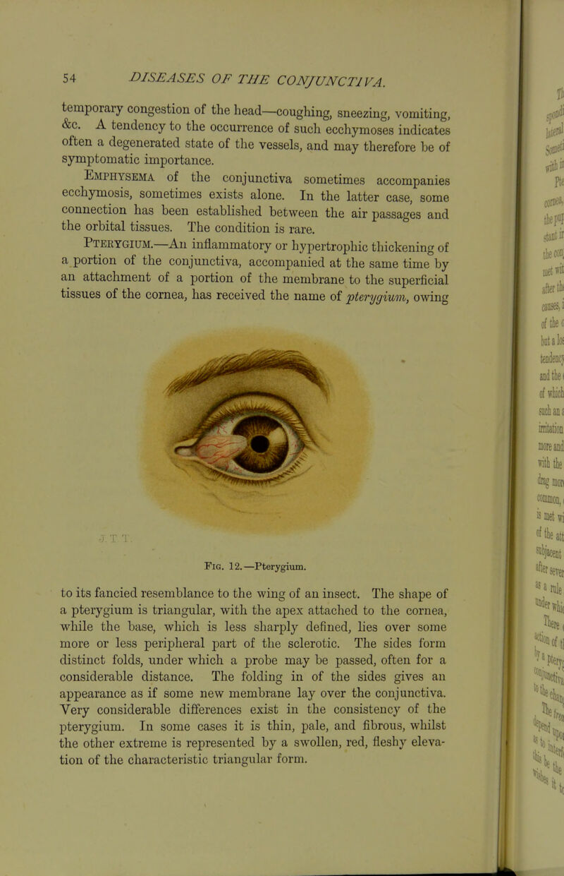 temporary congestion of the head—coughing, sneezing, vomiting, &c. A tendency to the occurrence of such ecchymoses indicates often a degenerated state of the vessels, and may therefore be of symptomatic importance. Emphysema of the conjunctiva sometimes accompanies ecchymosis, sometimes exists alone. In the latter case, some connection has been established between the air passages and the orbital tissues. The condition is rare. Pterygium.—An inflammatory or hypertrophic thickening of a portion of the conjunctiva, accompanied at the same time by an attachment of a portion of the membrane to the superficial tissues of the cornea, has received the name of pterygium, owing Fig. 12.—Pterygium. to its fancied resemblance to the wing of an insect. The shape of a pterygium is triangular, with the apex attached to the cornea, while the base, which is less sharply defined, lies over some more or less peripheral part of the sclerotic. The sides form distinct folds, under which a probe may be passed, often for a considerable distance. The folding in of the sides gives an appearance as if some new membrane lay over the conjunctiva. Very considerable differences exist in the consistency of the pterygium. In some cases it is thin, pale, and fibrous, whilst the other extreme is represented by a swollen, red, fleshy eleva- tion of the characteristic triangular form.