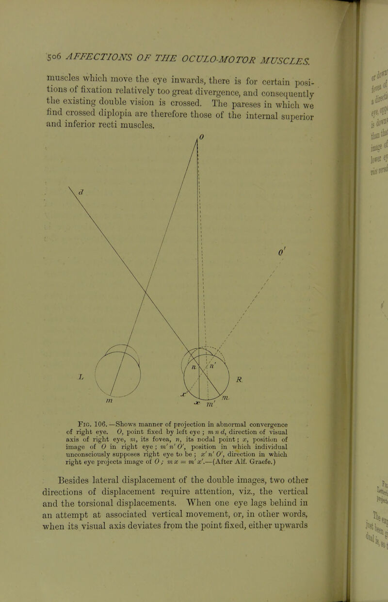 muscles which move the eye inwards, there is for certain posi- tions of fixation relatively too great divergence, and consequently the existing double vision is crossed. The pareses in which we find crossed diplopia are therefore those of the internal superior and inferior recti muscles. 0 Fig. 106. —Shows manner of projection in abnormal convergence of right eye. 0, point fixed by left eye ; m n d, direction of visual axis of right eye, m, its fovea, n, its nodal point; x, position of image of 0 in right eye ; m' n' 0', position in which individual unconsciously supposes right eye to be ; x'n'O', direction in which right eye projects image of 0; mx = m'x'.—(After Alf. Graefe.) Besides lateral displacement of the double images, two other directions of displacement require attention, viz., the vertical and the torsional displacements. When one eye lags beliind in an attempt at associated vertical movement, or, in other words, when its visual axis deviates from the point fixed, either upwards