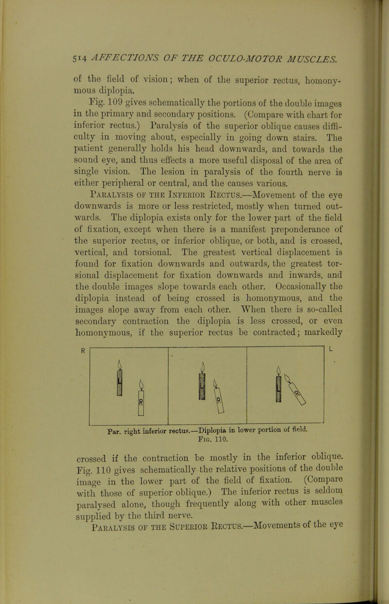 of the field of vision; when of the superior rectus, homony- mous diplopia. Fig. 109 gives schematically the portions of the double images in the primary a.nd secondary positions. (Compare with chart for inferior rectus.) Paralysis of the superior oblique causes difh- culty in moving about, especially in going down stairs. The patient generally holds his head downwards, and towards the sound eye, and thus effects a more useful disposal of the area of single vision. The lesion in paralysis of the fourth nerve is either peripheral or central, and the causes various. Paralysis of the Inferior Pectus.—Movement of the eye downwards is more or less restricted, mostly when turned out- wards. The diplopia exists only for the lower part of the field of fixation, except when there is a manifest preponderance of the superior rectus, or inferior oblique, or both, and is crossed, vertical, and torsional. The greatest vertical displacement is found for fixation downwards and outwards, the greatest tor- sional displacement for fixation downwards and inwards, and the double images slope towards each other. Occasionally the diplopia instead of being crossed is homonymous, and the images slope away from each other. When there is so-called secondary contraction the diplopia is less crossed, or even homonymous, if the superior rectus be contracted; markedly Par. right inferior rectus.—Diplopia in lower portion of field. Fig. 110. crossed if the contraction be mostly in the inferior oblique, rig. 110 gives schematically the relative positions of the double image in the lower part of the field of fixation. (Compare with those of superior oblique.) The inferior rectus is seldom paralysed alone, though frequently along with other muscles supplied by the third nerve. Paralysis of the Superior Pectus.—Movements of the eye