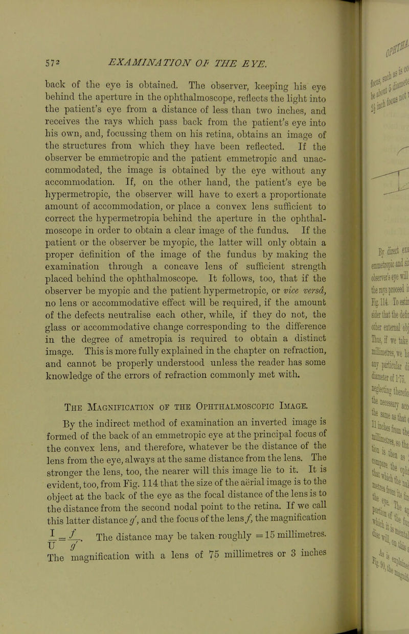 back of the eye is obtained. The observer, keeping his eye behind the aperture in the ophthalmoscope, reflects the liglit into the patient's eye from a distance of less than two inches, and receives the rays which pass back from the patient's eye into his own, and, focussing them on his retina, obtains an image of the structures from which they have been reflected. If the observer be emmetropic and the patient emmetropic and unac- commodated, the image is obtained by the eye without any accommodation. If, on the other hand, the patient's eye be hypermetropic, the observer will have to exert a proportionate amount of accommodation, or place a convex lens sufiicient to correct the hypermetropia behind the aperture in the ophthal- moscope in order to obtain a clear image of the fundus. If the patient or the observer be myopic, the latter will only obtain a proper definition of the image of the fundus by making the examination through a concave lens of sufiicient strength placed behind the ophthalmoscope. It follows, too, that if the observer be myopic and the patient hypermetropic, or vice versa, no lens or accommodative effect will be required, if the amount of the defects neutralise each other, while, if they do not, the glass or accommodative change corresponding to the difierence in the degree of ametropia is required to obtain a distinct image. This is more fully explained in the chapter on refraction, and cannot be properly understood unless the reader has some knowledge of the errors of refraction commonly met with. The Magnification of the Ophthalmoscopic Image. By the indirect method of examination an inverted image is formed of the back of an emmetropic eye at the principal focus of the convex lens, and therefore, whatever be the distance of the lens from the eye, always at the same distance from the lens. The stronger the lens, too, the nearer will this image lie to it. It is evident, too, from Fig. 114 that the size of the aerial image is to the object at the back of the eye as the focal distance of the lens is to the distance from the second nodal point to the retina. If we call this latter distance /, and the focus of the lens/, the magnification 1.=/_ The distance may be taken roughly = 15 millimetres. U / * The maf^nification with a lens of 75 millimetres or 3 inches