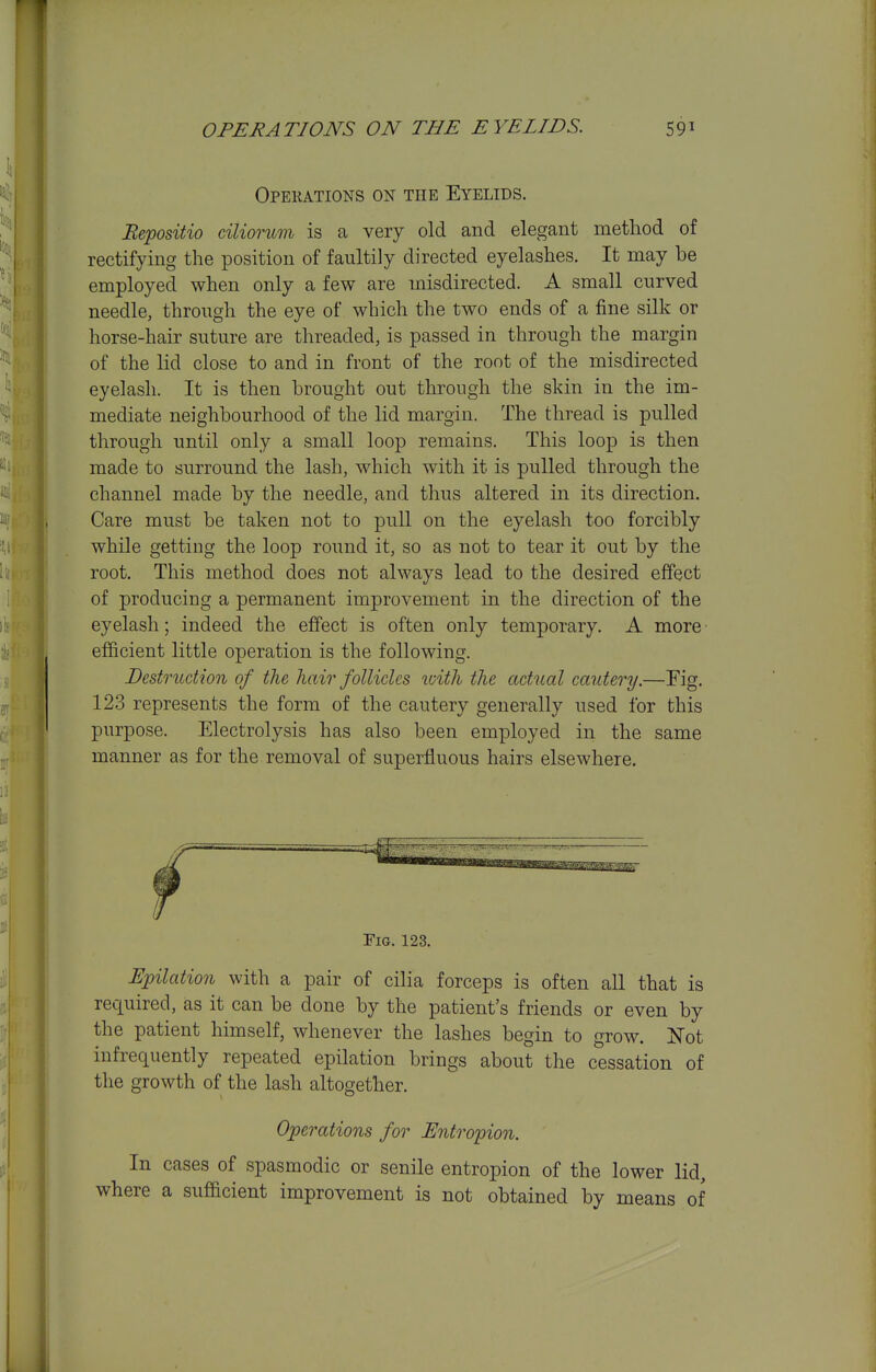 Opekations on the Eyelids. Bepositio ciliorum is a very old and elegant method of rectifying the position of faultily directed eyelashes. It may be employed when only a few are misdirected. A small curved needle, through the eye of which the two ends of a fine silk or horse-hair suture are threaded, is passed in through the margin of the lid close to and in front of the root of the misdirected eyelash. It is then brought out through the skin in the im- mediate neighbourhood of the lid margin. The thread is pulled through until only a small loop remains. This loop is then made to surround the lash, which with it is pulled through the channel made by the needle, and thus altered in its direction. Care must be taken not to pull on the eyelash too forcibly while getting the loop round it, so as not to tear it out by the root. This method does not always lead to the desired effect of producing a permanent improvement in the direction of the eyelash; indeed the effect is often only temporary. A more • efficient little operation is the following. Destruction of the hair follicles icith the actual cautery.—Fig. 123 represents the form of the cautery generally used for this purpose. Electrolysis has also been employed in the same manner as for the removal of superfluous hairs elsewhere. Fig. 123. Epilation with a pair of cilia forceps is often all that is required, as it can be done by the patient's friends or even by the patient himself, whenever the lashes begin to grow. Not infrequently repeated epilation brings about the cessation of the growth of the lash altogether. Operations for Entropion. In cases of spasmodic or senile entropion of the lower lid, where a sufificient improvement is not obtained by means of