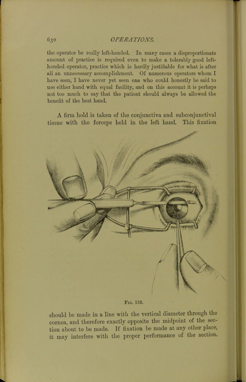 tlio. operator Le really Icft-liandcd. In many cases a disproportionate amount of practice is required even to make a tolerably good left- handed operator, practice which is hardly justifiable for what is after all an unnecessary accomplishment. Of numerous operators whom I have seen, I have never yet seen one who could honestly he said to use either hand with equal facility, and on this account it is perhaps not too much to say that the patient should always be allowed the benefit of the best hand. A firm hold is taken of the conjunctiva and subconjunctival tissue with the forceps held in the left hand. This fixation Fig. 138. should be made in a line with the vertical diameter through the cornea, and therefore exactly opposite the midpoint of the sec- tion about to be made. If fixation be made at any other place, it may interfere with the proper performance of the section.