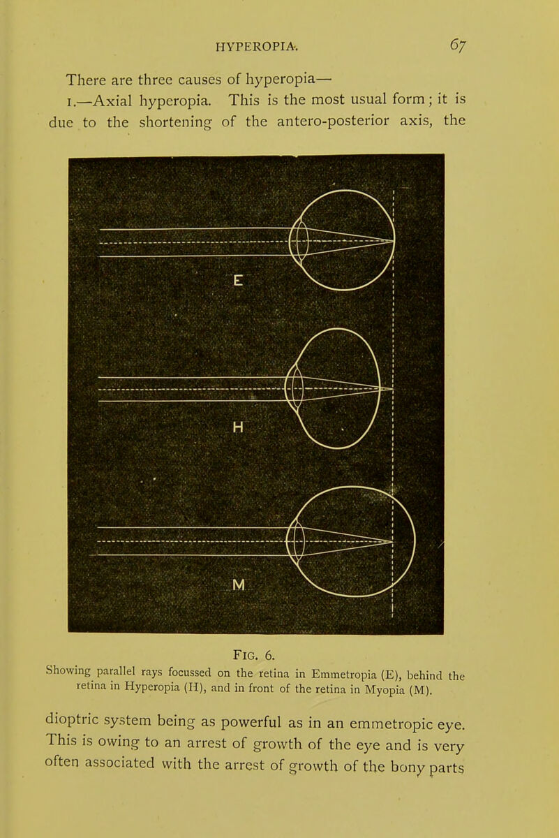 There are three causes of hyperopia— I.—Axial hyperopia. This is the most usual form; it is due to the shortening of the antero-posterior axis, the Fig. 6. Showing parallel rays focussed on the retina in Emmetropia (E), behind the retina in Hyperopia (H), and in front of the retina in Myopia (M). dioptric system being as powerful as in an emmetropic eye. This is owing to an arrest of growth of the eye and is very often associated with the arrest of growth of the bony parts