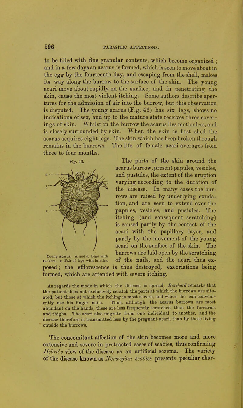 Fig. 46. to be filled with fine granular contents, which become organized ; and in a few days an acarus is formed, which is seen to move about in the egg by the fourteenth day, and escaping from the shell, makes its way along the burrow to the surface of the skin. The young acari move about rapidly on the surface, and in penetrating the skin, cause the most violent itching. Some authors describe aper- tures for the admission of air into the burrow, but this observation is disputed. The young acarus (Fig. 46) has six legs, shows no indications of sex, and up to the mature state receives three cover- ings of skin. Whilst in the burrow the acarus lies motionless, and is closely surrounded by skin. When the skin is first shed the acarus acquires eight legs. The skin which has been broken through remains in the burrows. The life of female acari averages from three to four months. The parts of the skin around the acarus burrow, present papules, vesicles, and pustules, the extent of the eruption varying according to the duration of the disease. In many cases the bur- rows are raised by underlying exuda- tion, and are seen to extend over the papules, vesicles, and pustules. The itching (and consequent scratching) is caused partly by the contact of the acari with the papillary layer, and partly by the movement of the young acari on the surface of the skin. The burrows are laid open by the scratching of the nails, and the acari thus ex- posed; the efflorescence is thus destroyed, excoriations being formed, which are attended with severe itching. As regards the mode in whicli the disease is spread, Burchard remarks that the patient does not exclusively scratch the parts at which the burrows are situ- ated, but those at which the itching is most severe, and where he can conveni- ently use his finger nails. Thus, although the acarus burrows are most abundant on the hands, these are less frequently scratched than the forearms and thighs. The acari also migrate from one individual to another, and the disease therefore is transmitted less by the pregnant acari, than by those living outside the burrows. Young Aoarus. a. and 6. Legs with luckers. c. Pair of legs with bristles. The concomitant affection of the skin becomes more and more extensive and severe in protracted cases of scabies, thus confirming Hehra's view of the disease as an artificial eczema. The variety of the disease known as Nonoegian scabies presents peculiar char-