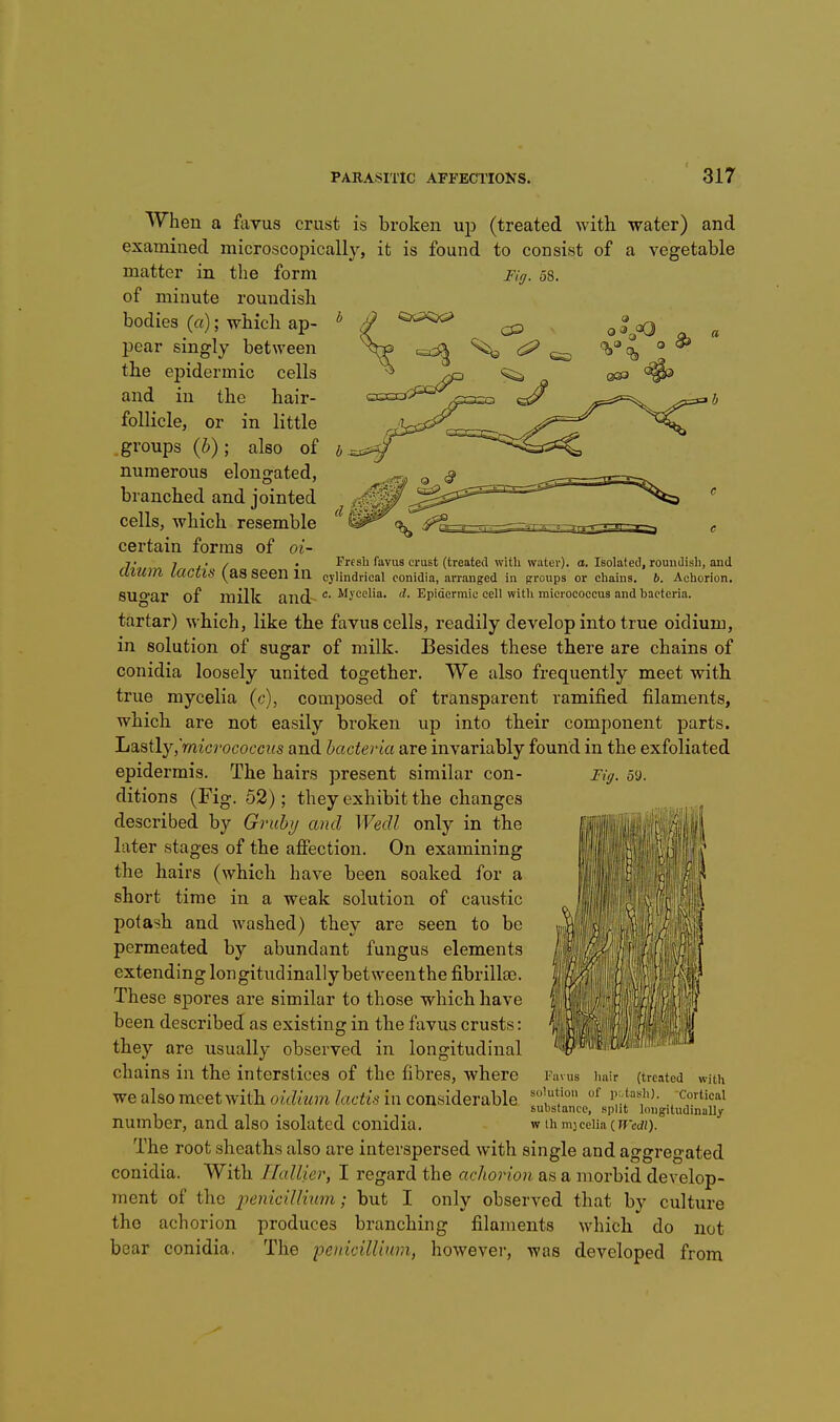 Fig. 58. When a ftivus crust is broken up (treated with water) and examined microscopically, it is found to consist of a vegetable matter in the form of minute roundish bodies (a); which ap- pear singly between the epidermic cells and in the hair- follicle, or in little groups {h); also of numerous elongated, branched and jointed cells, which resemble certain forms of 01- 7- 7 /■ / • Fresh favus crust (treated with water) CllUm lactlS (as seen m cylindrical conidia, arranged in proups or chains. sugar of milk and Mjceiia. a. Isolated, roundish, and 6. Achorion. d. Epidermic cell with micrococcus and bacteria. tartar) which, like the favus cells, readily develop into true oidium, in solution of sugar of milk. Besides these there are chains of conidia loosely united together. We also frequently meet with true mycelia (c), composed of transparent ramified filaments, which are not easily broken up into their component parts. JjdL^iXy,'micrococcus and bacteria are invariably found in the exfoliated epidermis. The hairs present similar con- Fig. 59. ditions (Fig. 52); they exhibit the changes described by Gruhj and Wedl only in the later stages of the afiection. On examining the hairs (which have been soaked for a short time in a weak solution of caustic potash and washed) they are seen to be permeated by abundant fungus elements extending longitudinallybetweenthe fibrillse. These spores are similar to those which have been described as existing in the favus crusts: they are usually observed in longitudinal chains in the interstices of the fibres, where we also meet with oidium lactis in considerable number, and also isolated conidia. The root sheaths also are interspersed with single and aggregated conidia. With Ilallier, I regard the achorion as a morbid develop- ment of the penicillium; but I only observed that by culture the achorion produces branching filaments which do not bear conidia. The penicillium, however, was developed from Favus hair (treated with solution of potash). Cortical substance, split longitudinally w th mjcelia (ff'cif)).