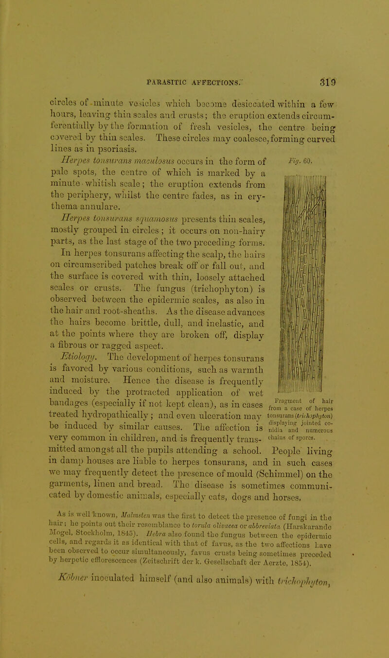 Fig. 60. 1 circles of-minute vehicles wMch become desiccated within a few- hours, leaving thin scales and crusts; the eruption extends circum- ferentially by the formation of fresh vesicles, the centre being covered by thin scales. These circles may coalesce; forming curved lines as in psoriasis. Herpes tonsurans maoulosus occurs in the form of pale spots, the centre of which is marked by a minute ■ whitish scale; the eruption extends from the periphery, whilst the centre fades, as in ery- thema annulare. Herpes tonsurans squamosus presents thin scales, mostly grouped in circles ; it occurs on non-hairy parts, as the last stage of the two preceding forms. In herpes tonsurans affecting the scalp, the Lairs on circumscribed patches break off or fall out, and the surface is covered with thin, loosely attached scales or crusts. The fungus (trichophyton) is observed between the epidermic scales, as also in the hair and root-sheaths. As the disease advances the hairs become brittle, dull, and inelastic, and at the points where they are broken off, display a fibrous or ragged aspect. Etiology. The development of herpes tonsurans is favored by various conditions, such as warmth and moisture. Hence the disease is frequently induced by the protracted application of wet bandages (especially if not kept clean), as incases JriTa':: ofhe^t treated liydropathicallv; and even ulceration raav tonsurans(tm/tsp/ijion) be induced by similr^r causes. The affection is ''t^lZ very common in children, and is frequently trans- °^ mitted amongst all the pupils attending a school. People living in damp houses are liable to herpes tonsurans, and in such cases Ave may frequently detect the presence of mould (Schimmel) on the garments, linen and bread. The disease is sometimes communi- cated by domestic animals, especially cats, dogs and horses. As is well Icnown, Mulmdcn was the first to detect the presence of fungi in the hau-; he points out their resemblance to torula oUvucea ov abbreviata (Harskarando Mogel, Stockholm, 1845). IJcbra also found the fungus between the epidermic cells, and regards it as identical with that of favus, as the two affections Lave been observed to occur simultaneously, favus crusts being sometimes preceded by herpetic efflorescences (Zcitschrift der k. Gesellschaft der Aerzte, 18o4). Kobner inoculated himself (and also animals) Avith triclmphyfon,