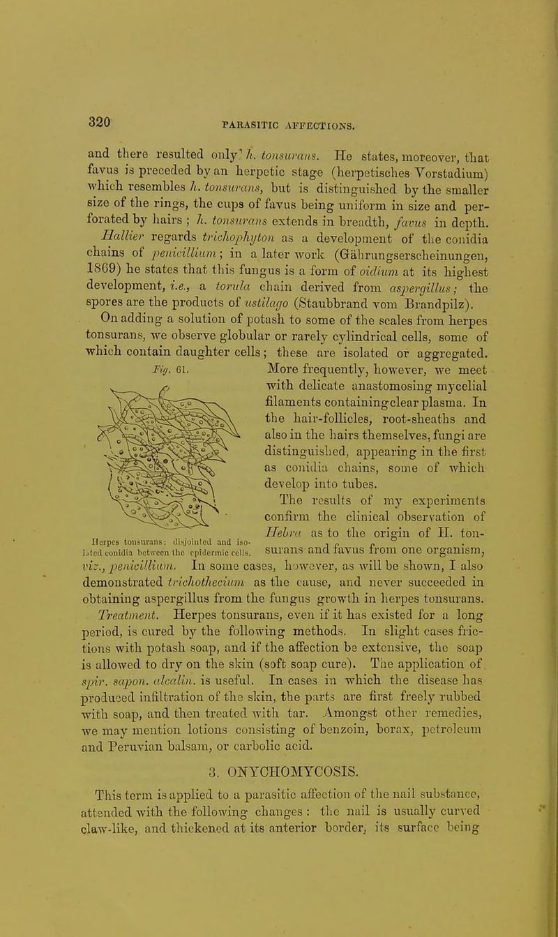 and there resulted only' h. tonsurans. He states, moreover, tliat fiivus is preceded by an herpetic stage (herpetisches Vorstadium) Avhich resembles h. tonsurans, but is distinguished by the smaller size of the rings, the cups of favus being uniform in size and per- forated by liairs ; Ji. tonsurans extends in breadth, favus in depth. Hallier regards trichophyton as a development of tlie conidia chains of penicillium; in a later work (Gahrungserscheinungen, 1869) he states that this fungus is a form of oidhtm at its highest development, z'.e., a torula chain derived from aspergillus; tlie spores are the products of ustilago (Staubbrand vom Brandpilz). On adding a solution of potash to some of the scales from berpes tonsurans, we observe globular or rarely cylindrical cells, some of which contain daughter cells; these are isolated or aggregated. Firj. 61. More frequently, however, we meet with delicate anastomosing mycelial filaments containing clear plasma. In the hair-follicles, root-sheaths and also in the hairs themselves, fungi are distinguished, appearing in the first as conidia chains, some of which develop into tubes. The results of my experiments confirm the clinical observation of Hehra as to the origin of II. ton- Ilcrpcs tonsurans: (Ii-;,joinlcil and iao- i i? L(c(i conidia Lohveen iiie epidermic cells, surans and lavus Irom ono organism, viz., penicilMum. In some cases, however, as will be shown, I also demonstrated trichotheciinn as the cause, and never succeeded in obtaining aspergillus from the fungus growth in herpes tonsvirans. Treatment. Herpes tonsurans, even if it bas existed for a long period, is cured by the following methods. In slight cases fric- tions with potash soap, and if the affection be extensive, the soap is allowed to dry on the skin (soft soap cure). The application of sjyir. sapon. alcalin. is useful. In cases in which the disease has produced infiltration of the skin, the parts are first freely rubbed with soap, and then treated with tar. Amongst other remedies, we may mention lotions consisting of benzoin, borax, petroleum and Peruvian balsam, or carbolic acid. 3. ONYCHOMYCOSIS. This term is applied to a parasitic affection of the nail sub.stancc, attended witb the following changes : the nail is usually curved claw-like, and thickened at its anterior border, its surface being