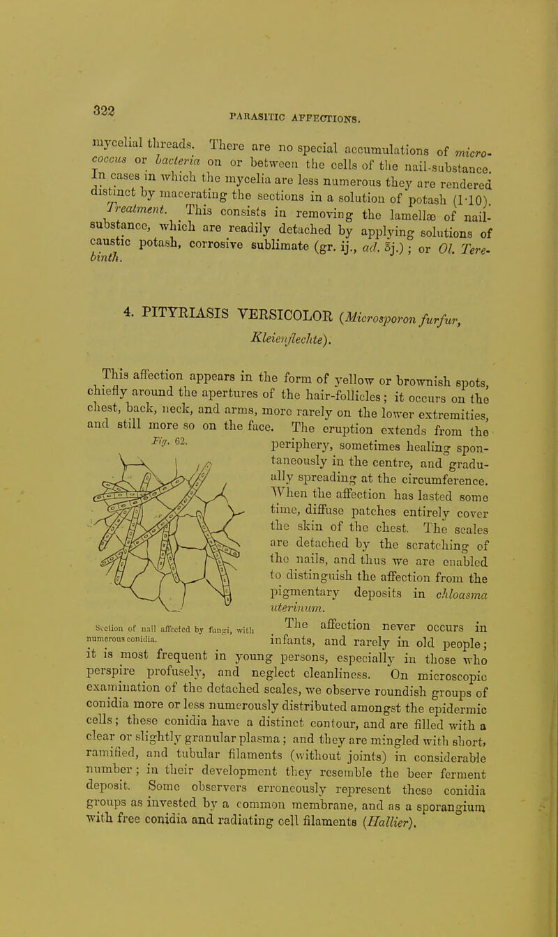 PARASITIC AFFECTIONS. mycelial threads. There are no special accumulations of micro- coccus or bacteria on or between the cells of the nail-substance In cases m which the mycelia are less numerous they are rendered distinct by macerating the sections in a solution of potash (MO) Jreatment. This consists in removing the lamellsB of nail- substance, which are readily detached by applying solutions of caustic potash, corrosive sublimate (gr. ij., ad. Sj.) : or 01. Tere- 4. PITYRIASIS VERSICOLOR {Microsporon furfur, Kleienflechte). This affection appears in the form of yellow or brownish spots, chiefly around the apertures of the hair-foUicles; it occurs on the chest, back, neck, and arms, more rarely on the lower extremities and Btill more so on the face. The eruption extends from the peripherj^ sometimes healing spon- taneously in the centre, and gradu- ally spreading at the circumference. When the affection has lasted some time, diffuse patches entirely cover the skin of the chest. The scales are detached by the scratching of the nails, and thus we are enabled to distinguish the affection from the pigmentary deposits in chloasma uterinum. The affection never occurs in . . infants, and rarely in old people; it IS most frequent in young persons, especially in those who perspire profusely, and neglect cleanliness. On microscopic examination of the detached scales, we observe roundish groups of conidia more or less numerously distributed amongst the epidermic cells; these conidia have a distinct contour, and are filled with a clear or slightly granular plasma; and they are mingled with short, ramified, and tubular filaments (without joints) in considerable number; in their development they resemble the beer ferment deposit. Some observers erroneously rejDresent these conidia groups as invested by a common membrane, and as a sporangium with free conidia and radiating cell filaments {Hallier). Suction of nail aflcctcd by fungi, with numerous conidia.