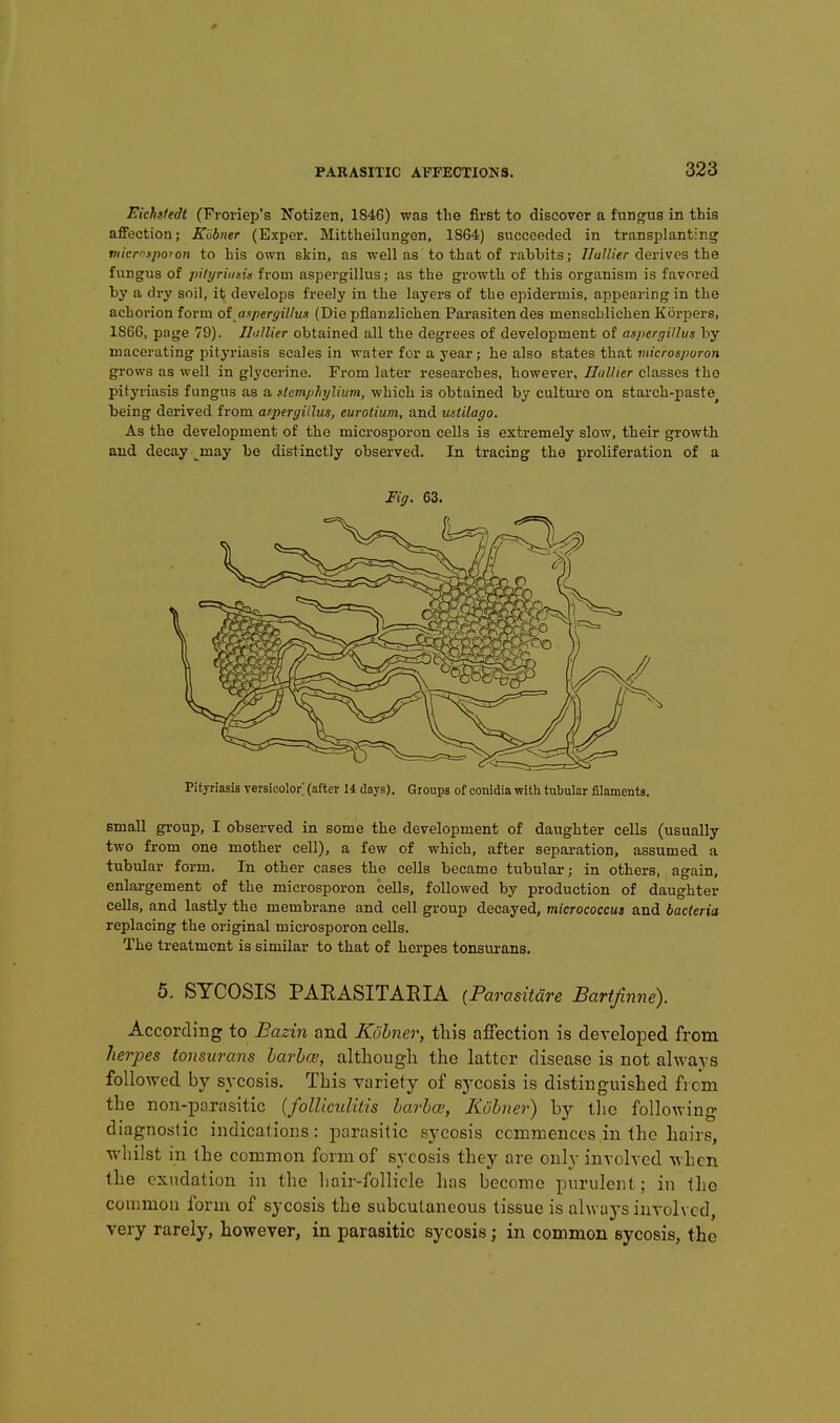 Eichsfedt (Froriep's Notizen, 1846) was the first to discover a fundus in this afiPection; K'obner (Exper. Mittheilungen, 1864) succeeded in transplanting niicmspoyon to his own skin, as well as to that of rabbits; 7/o/Zier derives the fungus of piti/riiiisis from aspergillus; as the growth of this organism is favored by a dry soil, ifc develops freely in the layers of the epidermis, appearing in the achorion form oi Aspergillus (Die pflanzlichen Parasiten des menschlichen Korpers, 1866, pnge 79). ILillier obtained all the degrees of development of aspergillus by macerating pityriasis scales in water for a year; he also states that 7?J!c/-cii7;oron grows as well in glycerine. From later researches, however, Hallier classes the pityriasis fungus as a Hcmiihyliim, which is obtained by culture on starch-paste^ being derived from aspergillus, eurotium, and ustilago. As the development of the microsporon cells is extremely slow, their growth and decay _^may be distinctly observed. In tracing the proliferation of a Fig. 63. Pityriasis versicolor' (after 14 days). Groups of conidia with tubular filaments. small group, I observed in some the development of daughter cells (usually two from one mother cell), a few of which, after separation, assumed a tubular form. In other cases the cells became tubular; in others, again, enlargement of the microsporon cells, followed by production of daughter cells, and lastly the membrane and cell group decayed, micrococcus and bacteria replacing the original microsporon cells. The treatment is similar to that of herpes tonsurans. 5, SYCOSIS PARASITARIA [Parasitare Bartjinne). According to Bazin and Kohner, this affection is develoiDed from herpes tonsurans larbce, although the latter disease is not always followed by sycosis. This variety of sycosis is distinguished from the non-para.sitic {folUciditis barhce, Kubner) by tlic following diagnostic indications: parasitic sycosis ccmnienccs in the hairs, whilst in the common form of sycosis they are only involved when the exudation in the hair-follicle has become purulent; in the common form of sycosis the subcutaneous tissue is always involved, very rarely, however, in parasitic sycosis; in common sycosis, the
