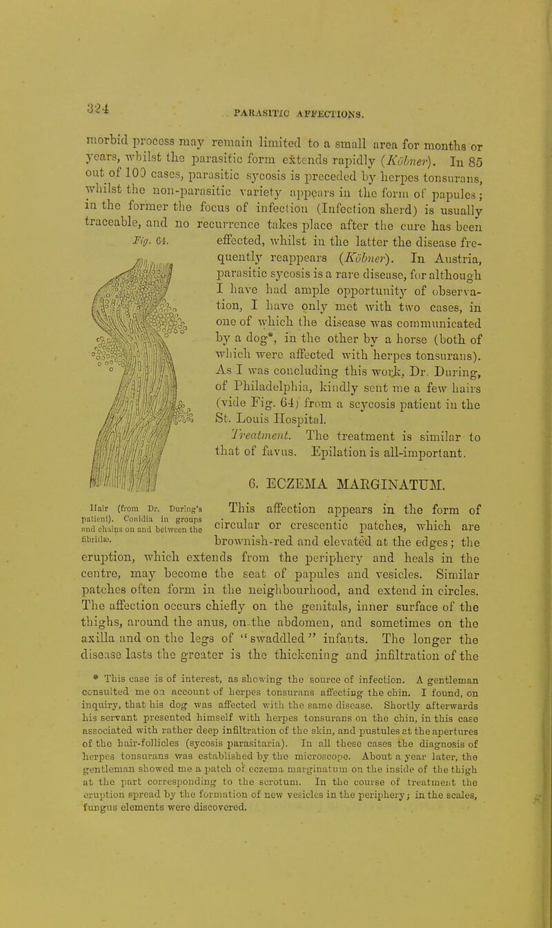 a24 PAKASmC AFFKCl'IONS. morbid process may remain limited to a small area for months or years, whilst the parasitic form extends rapidly (Kuhner). In 85 out of lOD cases, parasitic sj'cosis is preceded by herpes tonsurans, whilst the non-parasitic variety appears in the form of papules; m the former the focus of infection (Infection sherd) is usually traceable, and no recurrence takes place after the cure has been effected, whilst in the latter the disease fre- quently reappears {Kobner). In Austria, parasitic sycosis is a rare disease, for although I have had ample opportunity of observa- tion, I have only met with two cases, in one of which the disease was communicated by a dog*, in the other by a horse (both of which were affected with herpes tonsurans). As I was concluding this woiji, Dr. During, of Philadelphia, kindly sent me a few hairs (vide Fig. 64) frtmi a scycosis j^atieut in the St. Louis Hospital. Treatmenl. The treatment is similar to that of fuvus. Epilation is all-important. 6. ECZEMA MARGINATUM. Hair (from Dr. During's This affectiou appears in the form of patient). Conidia in groups • ^ . • ,1 i • 1 mul ehuius ou and behvecn the Circular or crcsccntic patches, which are brownish-red and elevated at the edges; the eruption, which extends from the periphery and heals in the centre, may become the seat of papules and vesicles. Similar patches often form in the neiglibourliood, and extend in circles. The affection occurs chiefly on the genitals, inner surface of the thighs, around the anus, on the abdomen, and sometimes on the axilla and on the legs of swaddled infants. The longer the disease lasts the greater is the thickening and infiltration of the • This case is of interest, as shewing the source of infeclion. A gentleman consulted me oa account of herpes tonsurans afifecting the chin. I found, on inquiry, that his dog was affected with the same disease. Shortly afterwards his servant presented himself with herpes tonsurans on the chin, in this case associated with rather deep infiltration of the skin, and pustules at the apertures of the hair-follicles (sycosis parasitaria). In aU these cases the diagnosis of herpes tonsurans was established by the microscope. About a year later, the gentleman showed nie a patch o\ eczema marginatum on the inside of the thigh at the part corresponding to the scrotum. In the course of treatment tho eruption spread by the foruiation of new vesicles in the periphery; in the scales, fungus elements were discovered.