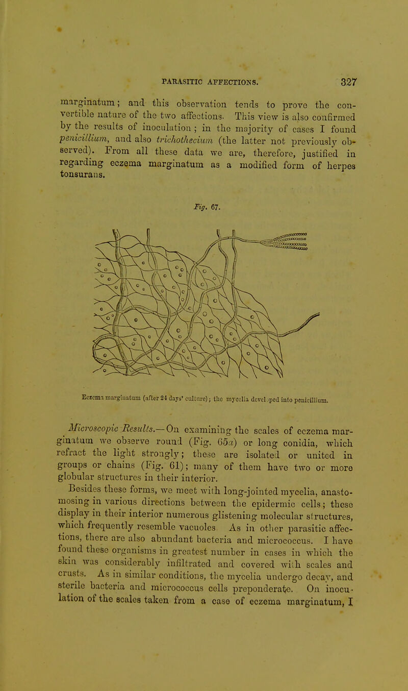 marginatum; and this observation tends to prove tlie con- vertible nature of the two affections. This view is also confirmed hy the results of inoculation ; in the majority of cases I found penicillium, and also trichothecium (the latter not previouslj^ ob- served). From all these data we are, therefore, justified in regarding eczema marginatum as a modified form of herpes tonsurans. Fiff. 67. Eczema marginatum (after 24 days* culture); the mycelia dcvebped info penicillium. ^ Microscopic Results.—On examining the scales of eczema mar- ginatum Ave observe round (Fig. 65a) or long conidia, which refract the light stroiigl}'; these are isolated or united in groups or chains (Fig. 61); many of them have two or more globular structures in their interior. Besides these forms, we meet with long-jointed mycelia, anasto- mosing in various directions between the' epidermic cells; these display in their interior numerous glistening molecular structures, which frequently resemble vacuoles As in otiier parasitic affec- tions, there are also abundant bacteria and micrococcus. I have found these organisms in greatest number in cases in which the skin Avas considerably infiltrated and covered wiih scales and crusts. As in similar conditions, the mycelia undergo decay, and sterile bacteria and micrococcus cells preponderat^e. On inocu- lation of the scales taken from a case of eczema marginatum, I