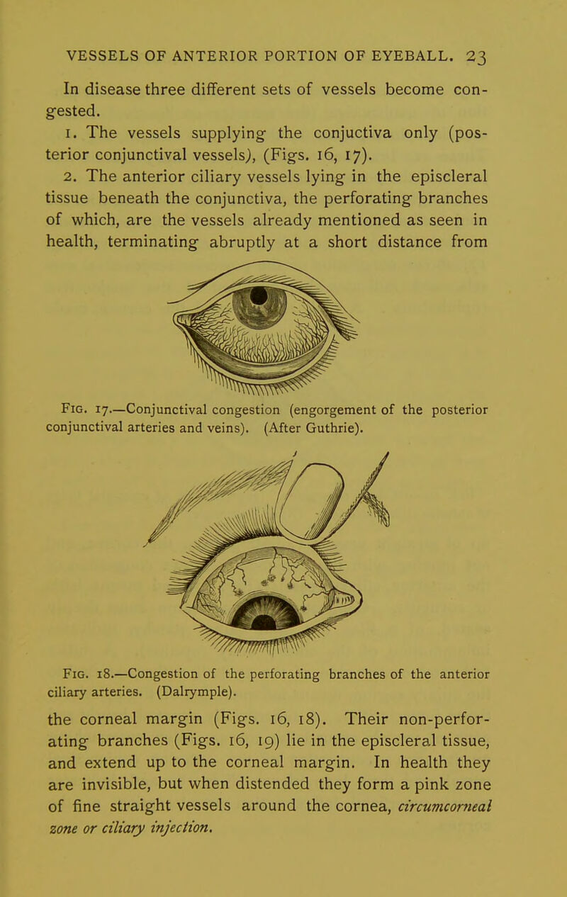In disease three different sets of vessels become con- gested. 1. The vessels supplying the conjuctiva only (pos- terior conjunctival vessels), (Figs. 16, 17). 2. The anterior ciliary vessels lying in the episcleral tissue beneath the conjunctiva, the perforating branches of which, are the vessels already mentioned as seen in health, terminating abruptly at a short distance from Fig. 17—Conjunctival congestion (engorgement of the posterior conjunctival arteries and veins). (After Guthrie). Fig. 18.—Congestion of the perforating branches of the anterior ciliary arteries. (Dalrymple). the corneal margin (Figs. 16, 18). Their non-perfor- ating branches (Figs. 16, 19) lie in the episcleral tissue, and extend up to the corneal margin. In health they are invisible, but when distended they form a pink zone of fine straight vessels around the cornea, circuTncorJieal zone or ciliary injection.