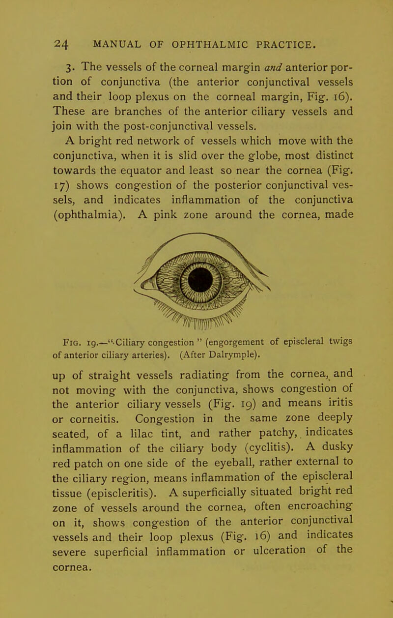 3. The vessels of the corneal margin and anterior por- tion of conjunctiva (the anterior conjunctival vessels and their loop plexus on the corneal margin, Fig. 16). These are branches of the anterior ciHary vessels and join with the post-conjunctival vessels. A bright red network of vessels which move with the conjunctiva, when it is slid over the globe, most distinct towards the equator and least so near the cornea (Fig. 17) shows congestion of the posterior conjunctival ves- sels, and indicates inflammation of the conjunctiva (ophthalmia). A pink zone around the cornea, made Fig. 19.—•Ciliary congestion (engorgement of episcleral twigs of anterior ciliary arteries). (After Dalrymple). up of Straight vessels radiating from the cornea, and not moving with the conjunctiva, shows congestion of the anterior ciliary vessels (Fig. 19) and means iritis or corneitis. Congestion in the same zone deeply seated, of a lilac tint, and rather patchy, indicates inflammation of the ciliary body (cyclitis). A dusky red patch on one side of the eyeball, rather external to the ciliary region, means inflammation of the episcleral tissue (episcleritis). A superficially situated bright red zone of vessels around the cornea, often encroaching on it, shows congestion of the anterior conjunctival vessels and their loop plexus (Fig. 16) and indicates severe superficial inflammation or ulceration of the cornea.