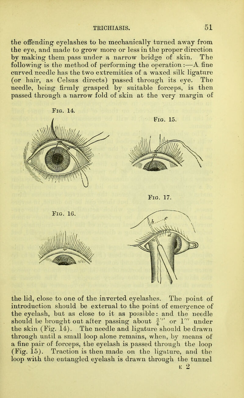 the offending eyelashes to be meclianically turned away from the eye, and made to grow more or less in the proper direction by making them pass under a narrow bridge of skin. The following is the method of performing the operation :—A fine curved needle has the two extremities of a waxed silk ligature (or hair, as Celsus directs) passed through its eye. The needle, being firmly grasped by suitable forceps, is then passed through a narrow fold of skin at the very margin of Fia. 14 the lid, close to one of the inverted eyelashes. The point of introduction should be external to the point of emergence of the eyelash, but as close to it as possible: and the needle should be brought out after passing about f''' or 1' under the skin (Fig. 14). The needle and ligature should be drawn through until a small loop alone remains, when, by means of a fine pair of forceps, the eyelash is passed through the loop (Fig. 15). Traction is then made on the ligature, and the loop with the entangled eyelash is drawn through the tunnel l£ 2