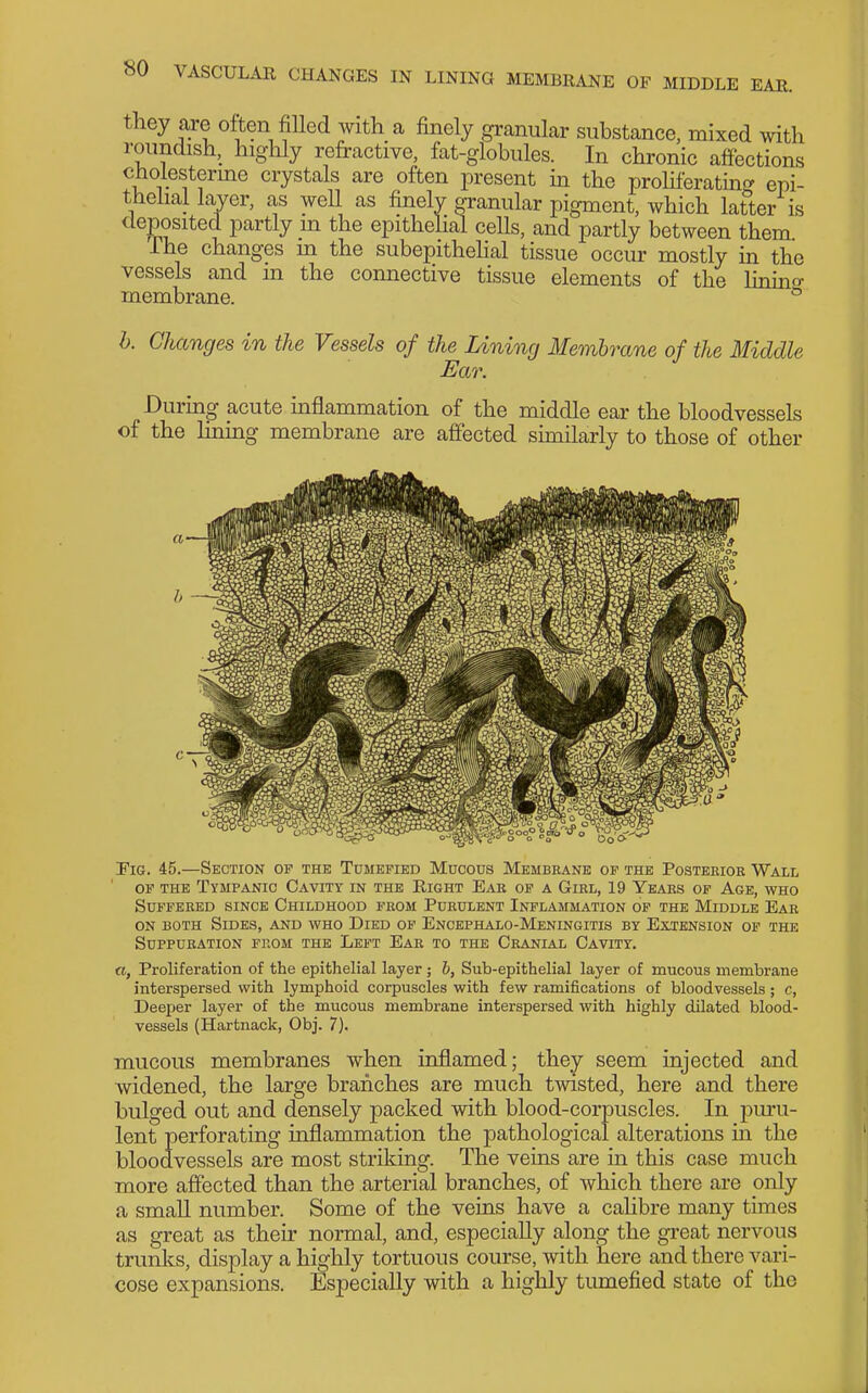 they are often fiUed with a finely granular substance, mixed \vith roundish, highly refractive, fat-globules. In chronic affections cholesterme crystals are often present m the proUferating epi- thelial layer, as weU as finely granular pigment, which latter is deposited partly m the epithelial cells, and partly between them ihe changes m the subej)ithehal tissue occur mostly m the vessels and m the connective tissue elements of the Knino- membrane. ® h. Changes in the Vessels of the Lining Membrane of the Middle Ear. During acute mflammation of the middle ear the bloodvessels of the Hning membrane are affected similarly to those of other PiGf. 45.—Section of the Tumefied Mucous Membrane of the Posterior Wall OF THE Tympanic Cavity in the Eight Ear of a Girl, 19 Years of Age, who Suffered since Childhood from Purulent Inflammation of the Middle Ear ON both Sides, and who Died of Encephalo-Meningitis by Extension of the Suppuration from the Left Ear to the Cranial Cavity. u, Proliferation of the epithelial layer ; h, Sub-epithelial layer of mucous membrane interspersed with lymphoid corpuscles with few ramifications of bloodvessels; c, Deeper layer of the mucous membrane interspersed with highly dilated blood- vessels (Hartnack, Obj. 7). mucous membranes when inflamed; they seem injected and widened, the large branches are much twisted, here and there bulged out and densely packed with blood-corpuscles. In puru- lent perforating inflammation the pathological alterations in the bloodvessels are most striking. The veins are in this case much more affected than the arterial branches, of which there are pnly a small number. Some of the veins have a cahbre many times as great as their normal, and, especially alon^ the great nervous trunks, display a highly tortuous course, with here and there vari- cose expansions. Especially with a highly tumefied state of the
