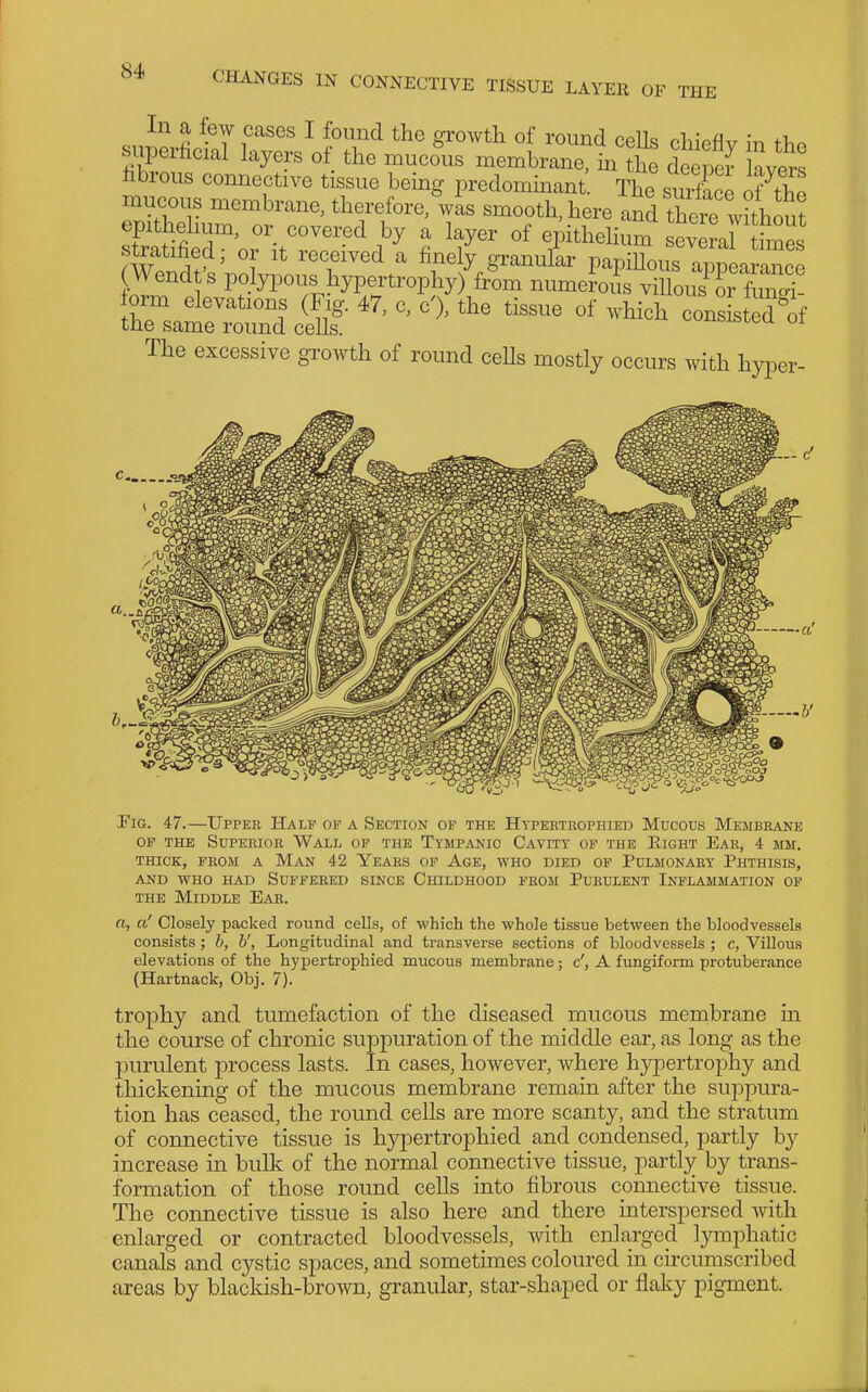 S ^ g^o^^th of round cells chieflv in the superficial layers of the mucous membrane, in the deeper lavers hbrous connective tissue being predominant The surface Ztho mucous membrane, therefore, wis smooth, here aS therl whhou? epithehum, or covered by a layer of epithehum evLal imes stratified; or it received a finely granullr papiUous appearance Wendt's polypous hypertrophy) from numeioi^s viUoui or wT ^^^^ -^^^^^ --^-^'of The excessive growth of round ceUs mostly occurs with hyper- s« b' Tig. 47.—Upper Half of a Section of the Hypektrophied Mucous Membrane OP THE Superior Wall of the Tympanic Cavity of the Right Ear, 4 mm. THICK, FROM A MaN 42 YeARS OF AgE, WHO DIED OF PULMONARY PHTHISIS, AND WHO HAD SUFFERED SINCE CHILDHOOD FROM PURULENT INFLAMMATION OF THE Middle Ear. a, a' Closely packed round cells, of which the whole tissue between the bloodvessels consists ; h, b', Longitudinal and transverse sections of bloodvessels ; c. Villous elevations of the hypertrophied mucous membrane; c', A fungiform protuberance (Hartnack, Obj, 7). trophy and tumefaction of the diseased mucous membrane in the course of chronic suppuration of the middle ear, as long as the purulent process lasts. In cases, however, where hypertrophy and thickening of the mucous membrane remain after the sujipura- tion has ceased, the round cells are more scanty, and the stratum of connective tissue is hypertrophied and condensed, partly by increase in bulk of the normal connective tissue, partly by trans- formation of those round cells into fibrous connective tissue. The connective tissue is also here and there interspersed with enlarged or contracted bloodvessels, with enlarged lymphatic canals and cystic spaces, and sometimes coloured in circumscribed areas by blacldsh-brown, granular, star-shaped or flaky pigment.