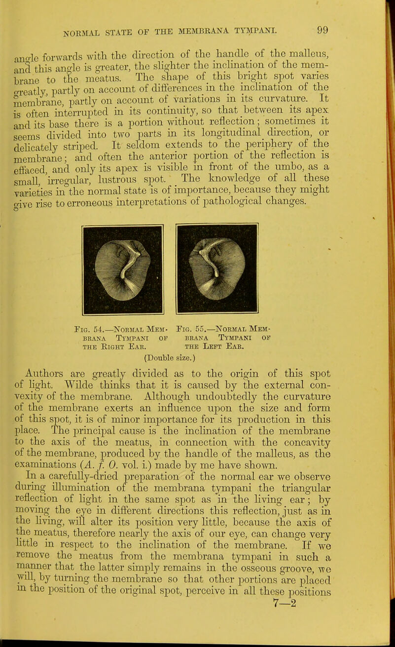 aiio-le forwards with the direction of the handle of the malleus, anS this ano-le is greater, the slighter the inclination of the mem- brane to tL meatus. The shape of this bright spot varies o-reatly partly on account of difi'erences in the mclmation of the membrane, partly on account of variations in its curvature. It is often interrupted in its continuity, so that between its apex and its base there is a portion without reflection; sometimes it seems divided into two parts in its longitudinal direction, or dehcately striped. It seldom extends to the periphery of the membrane; and often the anterior portion of the reflection is eff'aced, and only its apex is visible in front of the umbo, as a small, 'irregular, lustrous s]30t. The knowledge of all these varieties in the normal state is of importance, because they might o-ive rise to erroneous interpretations of pathological changes. Tig. 54.—Nobmal Mem- Fig. 55.—Normal Mem- BKANA TtMPANI OP BRANA TyMPANI OF THE Right Ear. the Left Ear. (Double size.) Authors are greatly divided as to the origin of this spot of hght. Wilde thinks that it is caused by the external con- vexity of the membrane. Although undoubtedly the curvature of the membrane exerts an influence upon the size and form of this spot, it is of minor importance for its production in this place. The principal cause is the inclination of the membrane to the axis of the meatus, in connection with the concavity of the membrane, produced by the handle of the malleus, as the examinations (A. f. 0. vol. i.) made by me have shown. In a carefully-dried preparation of the normal ear we observe during illumination of the membrana tympani the triangular reflection of light in the same spot as in the living ear; by moving^ the eye in different directions this reflection, just as in the living, will alter its position very little, because the axis of the meatus, therefore nearly the axis of our eye, can change very little in respect to the inclination of the membrane. If we remove the meatus from the membrana tympani in such a manner that the latter simply remains in the osseous groove, we will, by turning the membrane so that other portions are placed m the position of the original spot, perceive in all these positions 7—2