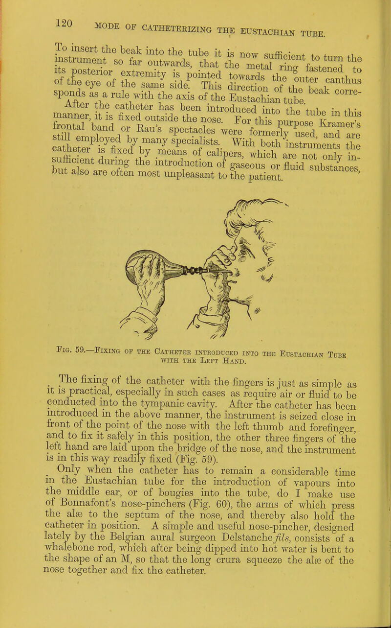 r = & 54^ frontal band or Rau's spectacles ^ £0^^^^^^^^ ^andT;' fl:^''rleir''' ™' ^^^^^^^^ th catneter is fixed by means of calipers, which are not only in- buf Ssfar^o?^^ introduction of^^aseous or fluid subsZces, Dut also are often most unpleasant to the patient. Tig. 59,—Fixing op the Catheter introduced into the Eustachian Tube WITH THE Left Hand. _ The fixing of the catheter with the fingers is just as simple as it is practical, especially m such cases as require air or fluid to be conducted into the tympanic cavity. After the catheter has been introduced m the above manner, the mstrument is seized close in front of the point of the nose with the left thumb and forefinger, and to fix it safely in this position, the other thi^ee fingers of the left hand are laid upon the bridge of the nose, and the instrument is m this way readily fixed (Fig. 59). Only when the catheter has to remam a considerable time in the_ Eustachian tube for the mtroduction of vapom's into the middle ear, or of bougies into the tube, do I make use of Bonnafont's nose-pm.chers (Fig. 60), the arms of which press the alse to the septum of the nose, and thereby also hold the catheter in position. A simple and useful nose-pincher, designed lately by the Belgian aural surgeon Delstanche_;?is, consists of a whalebone rod, which after being dipped mto hot water is bent to the shape of an M, so that the long crm'a squeeze the alse of the nose together and fix th.& catheter.