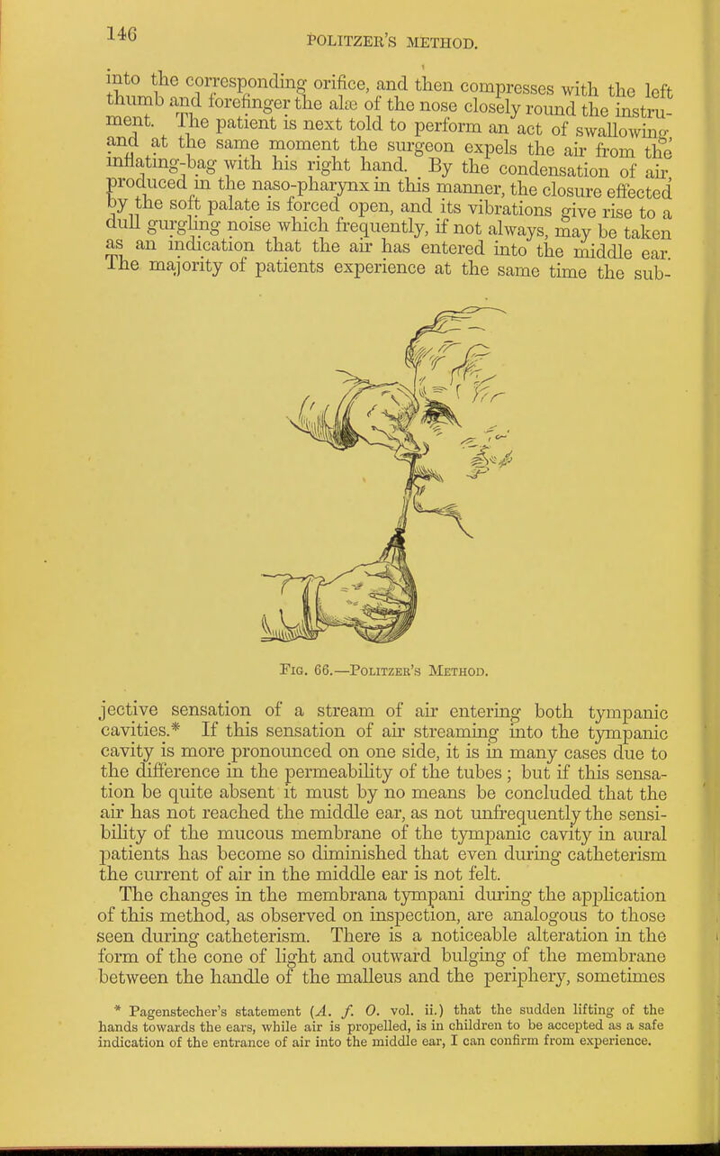 , 1 mto tlie corresponding orifice, and then compresses with the left ^iimb and lorefinger the ahe of the nose closily round the instru- ment. The patient is next told to perform an act of swaUowmo- and at the same moment the surgeon expels the air from th^'e mllatmg-bag with his right hand. By the condensation of ah^ produced m the naso-pharynx m this mamier, the closure effected by the soft palate is forced open, and its vibrations give rise to a duU gurghng noise which frequently, if not always, may be taken as an indication that the au' has entered into the middle ear The majority of patients experience at the same time the sub- Tig. 66.—Politzer's Method. jective sensation of a stream of air entering both tympanic cavities.* If this sensation of air streaming into the tympanic cavity is more pronounced on one side, it is in many cases due to the difference in the permeabihty of the tubes ; but if this sensa- tion be quite absent it must by no means be concluded that the air has not reached the middle ear, as not unfrequently the sensi- bility of the mucous membrane of the tympanic cavity in aural patients has become so diminished that even during catheterism the current of air in the middle ear is not felt. The changes in the membrana tympani during the apjsHcation of this method, as observed on inspection, are analogous to those seen during catheterism. There is a noticeable alteration in the form of the cone of light and outward bulging of the membrane between the handle of the malleus and the periphery, sometimes * Pagenstecher's statement {A. f. 0. vol. ii.) that the sudden lifting of the hands towards the ears, while air is propelled, is in children to be accepted as a safe indication of the entrance of air into the middle ear, I can confirm from experience.