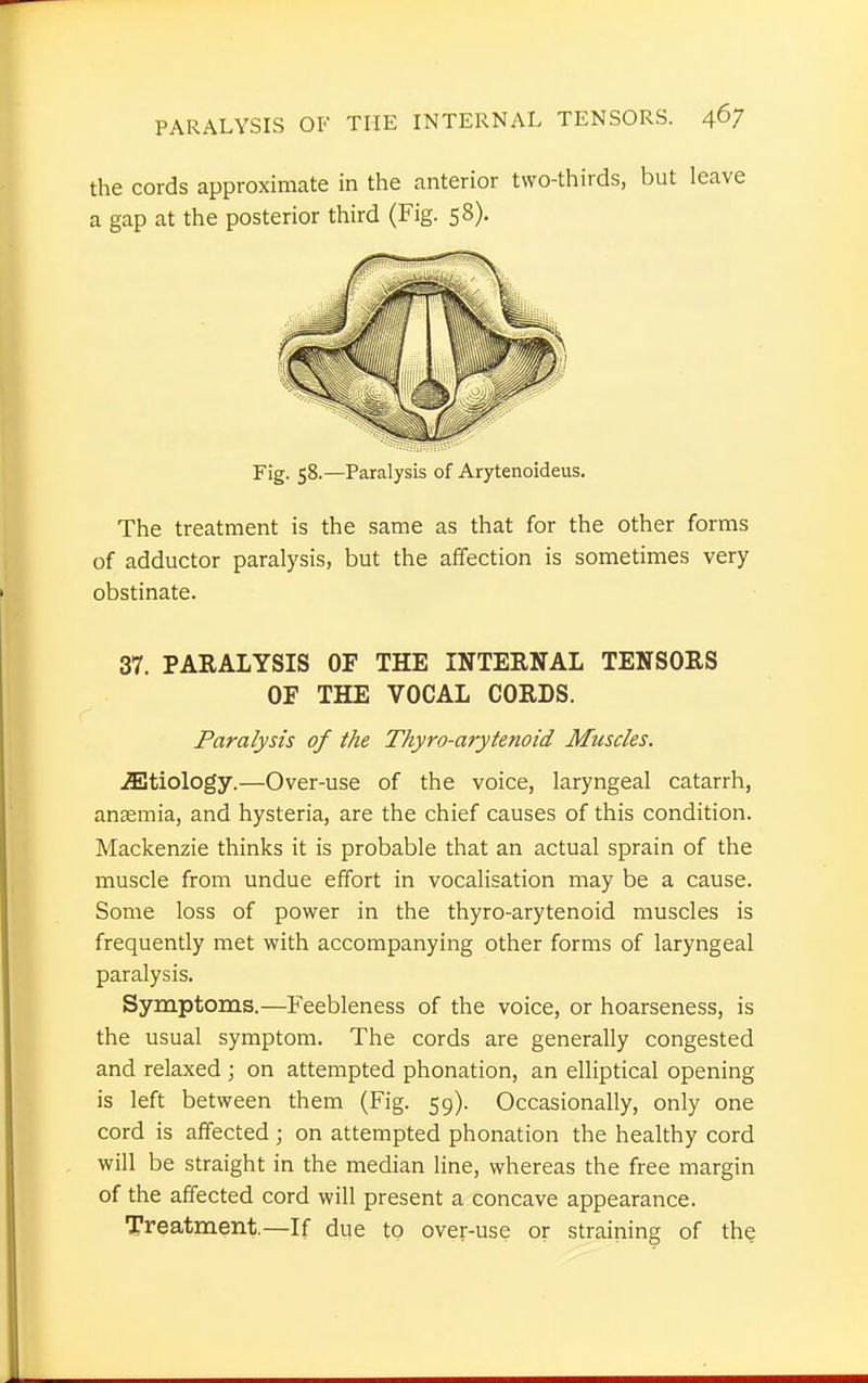 the cords approximate in the anterior two-thirds, but leave a gap at the posterior third (Fig. 58). Fig. 58.—Paralysis of Arytenoideus. The treatment is the same as that for the other forms of adductor paralysis, but the affection is sometimes very- obstinate. 37. PARALYSIS OF THE INTERNAL TENSORS OF THE VOCAL CORDS. Paralysis of the Thyro-arytenoid Muscles. etiology.—Over-use of the voice, laryngeal catarrh, anaemia, and hysteria, are the chief causes of this condition. Mackenzie thinks it is probable that an actual sprain of the muscle from undue effort in vocalisation may be a cause. Some loss of power in the thyro-arytenoid muscles is frequently met with accompanying other forms of laryngeal paralysis. Symptoms.—Feebleness of the voice, or hoarseness, is the usual symptom. The cords are generally congested and relaxed ; on attempted phonation, an elliptical opening is left between them (Fig. 59). Occasionally, only one cord is affected ; on attempted phonation the healthy cord will be straight in the median line, whereas the free margin of the affected cord will present a concave appearance. Treatment.—If due to over-use or straining of the