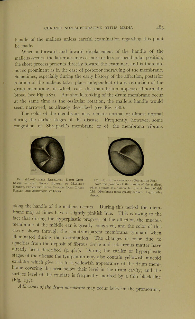 handle of the malleus unless careful examination regarding this point be made. When a forward and inward displacement of the handle of the malleus occurs, the latter assumes a more or less perpendicular position, the short process presents directly toward the examiner, and is therefore not so prominent as in the case of posterior indrawing of the membrane. Sometimes, especially during the early history of the affection, posterior rotation of the malleus takes place independent of any retraction of the drum membrane, in which case the manubrium appears abnormally broad (see Fig. 282). But should sinking of the drum membrane occur at the same time as the ossicular rotation, the malleus handle would seem narrowed, as already described (see Fig. 286). The color of the membrane may remain normal or almost normal during the earlier stages of the disease. Frequently, however, some congestion of Shrapnell's membrane or of the membrana vibrans Fig. 286.—Greatly Retracted Drum Mem- Fig. 287—Supernumerary Posterior Fold, brane showing Sharp Border of Malleus Note the position of the handle of the malleus, Handle, Prominent Short Process Long Light which appears as a narrow line just in front of this Reflex, and Adhesions at Umbo. fold. Membrana tensa greatly sunken. Light reflex absent. along the handle of the malleus occurs. During this period the mem- brane may at times have a slightly pinkish hue. This is owing to the fact that during the hyperplastic progress of the affection the mucous membrane of the middle ear is greatly congested, and the color of this cavity shows through the semitransparent membrana tympani when illuminated during the examination. The changes in color due to opacities from the deposit of fibrous tissue and calcareous matter have already been described (p. 481). During the earlier or hyperplastic stages of the disease the tympanum may also contain yellowish mucoid exudates which give rise to a. yellowish appearance of the drum mem- brane covering the area below their level in the drum cavity; and the surface level of the exudate is frequently marked by a thin black line 137)- Adhesions of the drum membrane may occur between the promontory