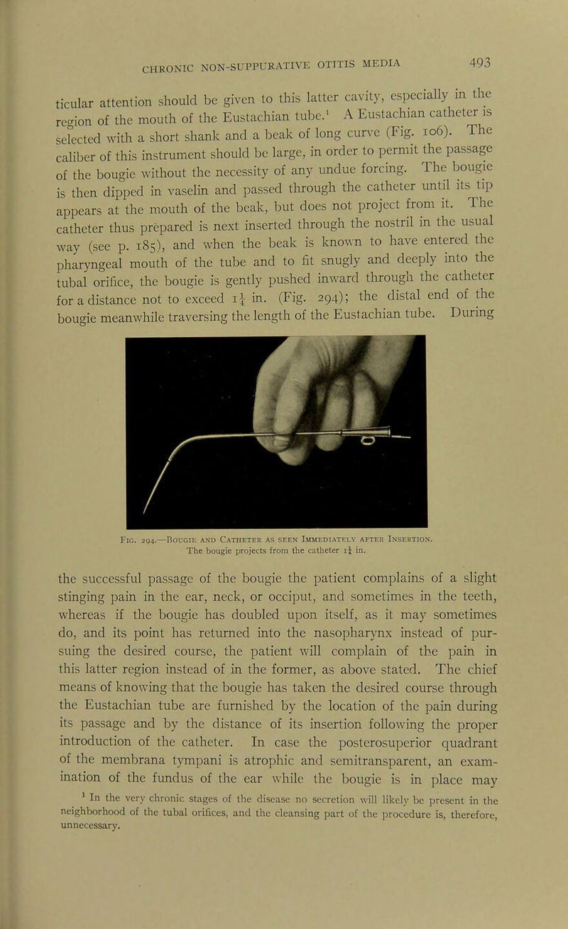 ticular attention should be given to this latter cavity, especially in the region of the mouth of the Eustachian tube.1 A Eustachian catheter is selected with a short shank and a beak of long curve (Fig. 106). The caliber of this instrument should be large, in order to permit the passage of the bougie without the necessity of any undue forcing. The bougie is then dipped in vaselin and passed through the catheter until its tip appears at the mouth of the beak, but does not project from it. The catheter thus prepared is next inserted through the nostril in the usual way (see p. 185), and when the beak is known to have entered the pharyngeal mouth of the tube and to fit snugly and deeply into the tubal orifice, the bougie is gently pushed inward through the catheter for a distance not to exceed i£ in. (Fig. 294); the distal end of the bougie meanwhile traversing the length of the Eustachian tube. During / Fig. 294.—Bougie and Catheter as seen Immediately after Insertion. The bougie projects from the catheter ij in. the successful passage of the bougie the patient complains of a slight stinging pain in the ear, neck, or occiput, and sometimes in the teeth, whereas if the bougie has doubled upon itself, as it may sometimes do, and its point has returned into the nasopharynx instead of pur- suing the desired course, the patient will complain of the pain in this latter region instead of in the former, as above stated. The chief means of knowing that the bougie has taken the desired course through the Eustachian tube are furnished by the location of the pain during its passage and by the distance of its insertion following the proper introduction of the catheter. In case the posterosuperior quadrant of the membrana tympani is atrophic and semitransparent, an exam- ination of the fundus of the ear while the bougie is in place may 1 In the very chronic stages of the disease no secretion will likely be present in the neighborhood of the tubal orifices, and the cleansing part of the procedure is, therefore, unnecessary.