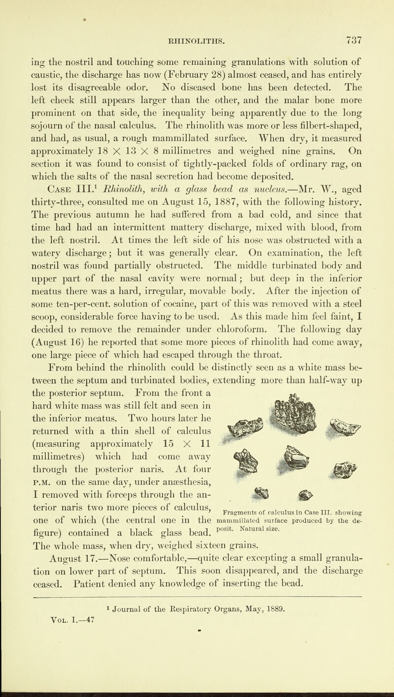 ing the nostril and touching some remaining granulations with solution of caustic, the discharge has now (February 28) almost ceased, and has entirely lost its disagreeable odor. No diseased bone has been detected. The left cheek still appears larger than the other, and the malar bone more prominent on that side, the inequality being apparently due to the long sojourn of the nasal calculus. The rhinolith was more or less filbert-shaped, and had, as usual, a rough mammillated surface. When dry, it measured approximately 18 X 13 X 8 millimetres and weighed nine grains. On section it was found to consist of tightly-packed folds of ordinary rag, on which the salts of the nasal secretion had become deposited. Case III.1 Rhinolith, with a glass bead as nucleus.—Mr. W., aged thirty-three, consulted me on August 15, 1887, with the following history. The previous autumn he had suffered from a bad cold, and since that time had had an intermittent mattery discharge, mixed with blood, from the left nostril. At times the left side of his nose was obstructed with a watery discharge; but it was generally clear. On examination, the left nostril was found partially obstructed. The middle turbinated body and upper part of the nasal cavity were normal; but deep in the inferior meatus there was a hard, irregular, movable body. After the injection of some ten-per-cent, solution of cocaine, part of this was removed with a steel scoop, considerable force having to be used. As this made him feel faint, I decided to remove the remainder under chloroform. The following day (August 16) he reported that some more pieces of rhinolith had come away, one large piece of which had escaped through the throat. From behind the rhinolith could be distinctly seen as a white mass be¬ tween the septum and turbinated bodies, extending more than half-way up the posterior septum. From the front a hard white mass was still felt and seen in the inferior meatus. Two hours later he returned with a thin shell of calculus (measuring approximately 15 X 11 millimetres) which had come away through the posterior naris. At four p.m. on the same day, under antesthesia, I removed with forceps through the an¬ terior naris two more pieces of calculus, one of which (the central one in the figure) contained a black glass bead. The whole mass, when dry, weighed sixteen grains. August 17.—Nose comfortable,—quite clear excepting a small granula¬ tion on lower part of septum. This soon disappeared, and the discharge ceased. Patient denied any knowledge of inserting the bead. Fragments of calculus in Case III. showing mammillated surface produced by the de¬ posit. Natural size. 1 Journal of the Respiratory Organs, May, 1889. Vol. I.—47