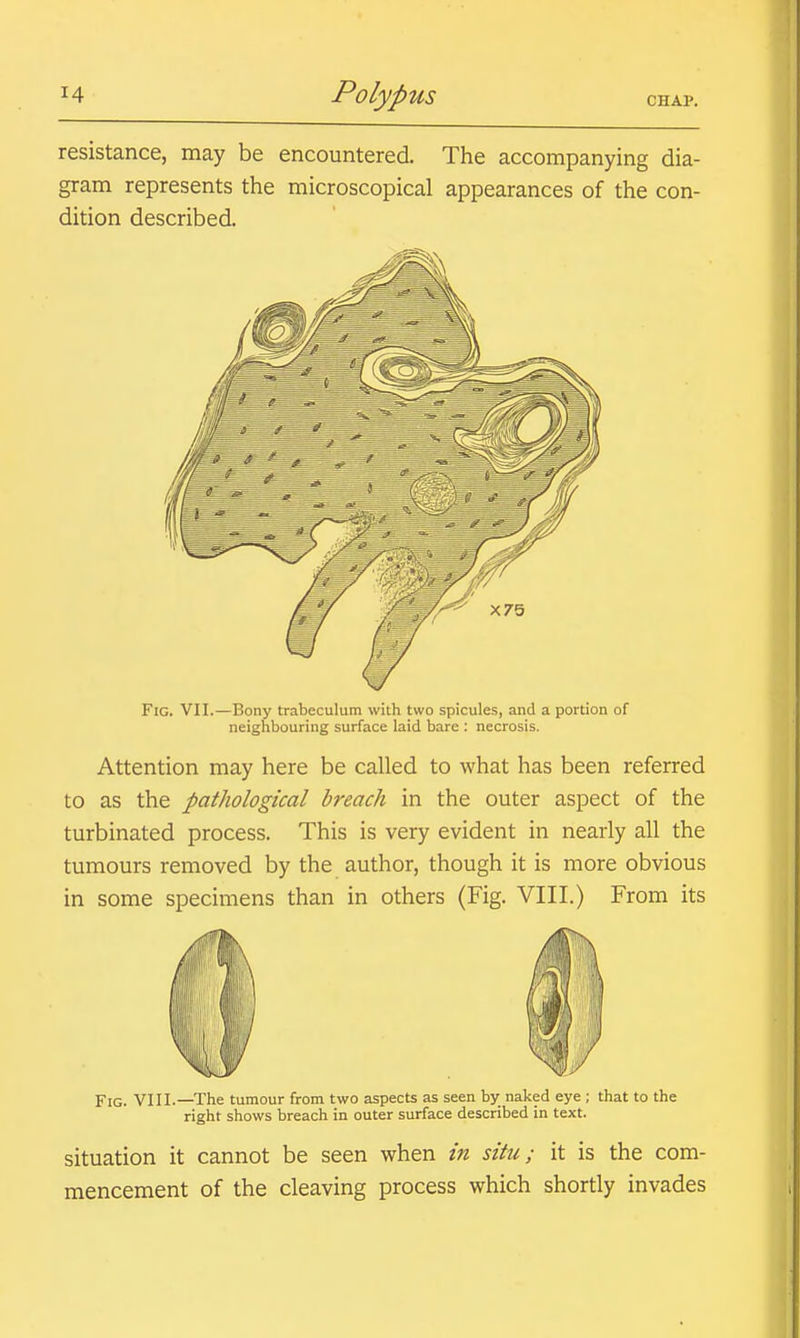 resistance, may be encountered. The accompanying dia- gram represents the microscopical appearances of the con- dition described. Fig. VII.—Bony trabeculum with two spicules, and a portion of neighbouring surface laid bare : necrosis. Attention may here be called to what has been referred to as the pathological breach in the outer aspect of the turbinated process. This is very evident in nearly all the tumours removed by the author, though it is more obvious in some specimens than in others (Fig. VIII.) From its Fig. VI11.—The tumour from two aspects as seen by naked eye ; that to the right shows breach in outer surface described in text. situation it cannot be seen when in situ; it is the com- mencement of the cleaving process which shortly invades