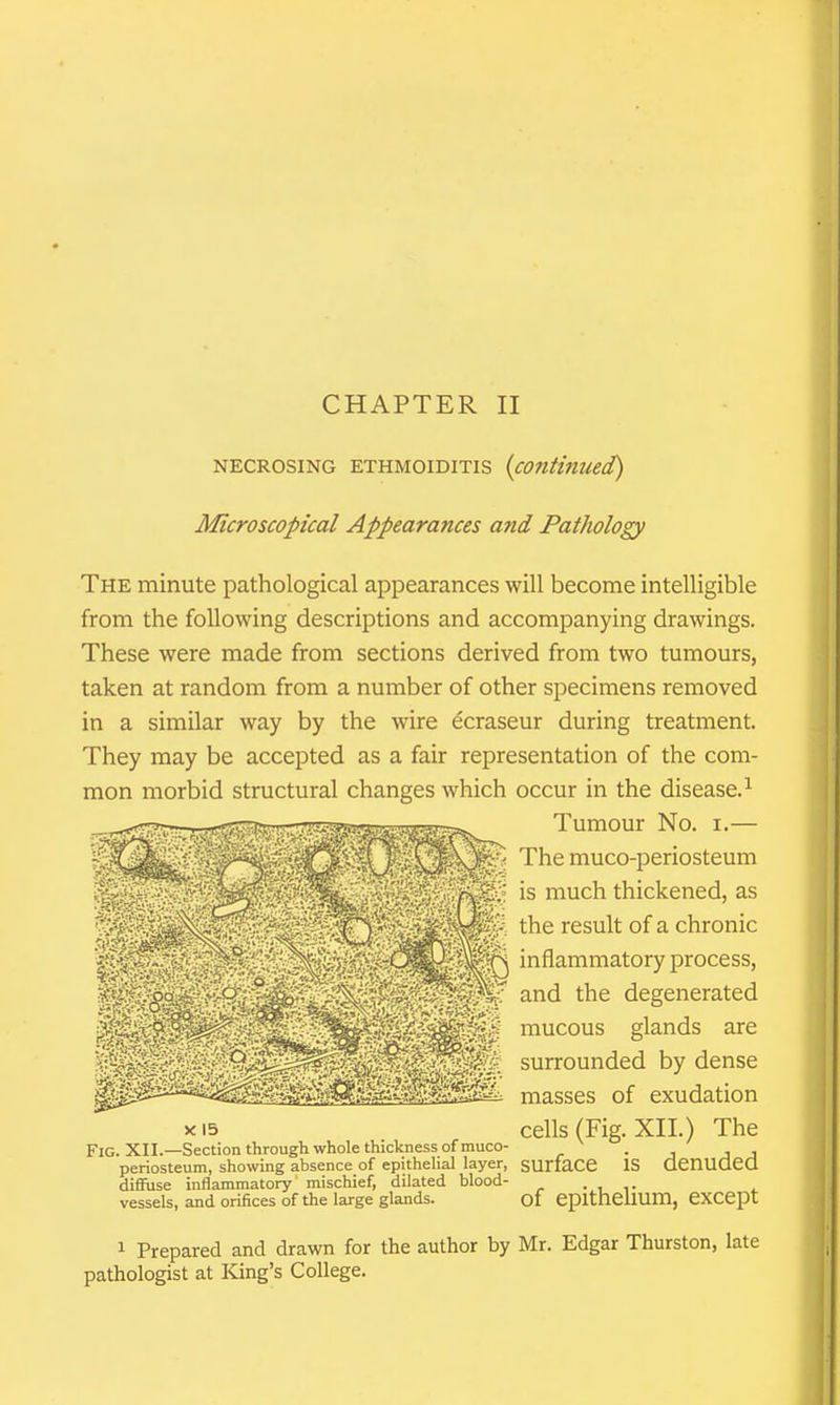 NECROSING ETHMOIDITIS {continued) Microscopical Appearances a7id Pathology The minute pathological appearances will become intelligible from the following descriptions and accompanying drawings. These were made from sections derived from two tumours, taken at random from a number of other specimens removed in a similar way by the wire ^craseur during treatment. They may be accepted as a fair representation of the com- mon morbid structural changes which occur in the disease.^ Tumour No. i.— The muco-periosteum is much thickened, as the result of a chronic inflammatory process, ^^ and the degenerated mucous glands are surrounded by dense masses of exudation cells (Fig. XII.) The surface is denuded of epithelium, except y. 15 Fig. XII.—Section through whole thickness of muco- periosteum, showing absence of epithelial layer, diffuse inflammatory' mischief, dilated blood- vessels, and orifices of the large glands. 1 Prepared and drawn for the author by Mr. Edgar Thurston, late pathologist at King's College.