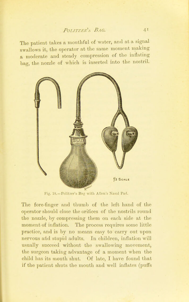 Politzer's Bag. The patient takes a mouthful of water, and at a signal swallows it, the operator at the same moment making a moderate and steady compression of the inflating bag, the nozzle of which is inserted into the nostril. Fig. IS.—Politzer's Bug witll Allen's Nasal Pad. The fore-finder and thumb of the left hand of the operator should close the orifices of the nostrils round the nozzle, by compressing them on each side at the moment of inflation. The process requires some little practice, and is by no means easy to carry out upon nervous and stupid adults. In children, inflation will usually succeed without the swallowing movement, the surgeon taking advantage of a moment when the child has its mouth shut. Of late, I have found that if the patient shuts the mouth and well inflates (puffs