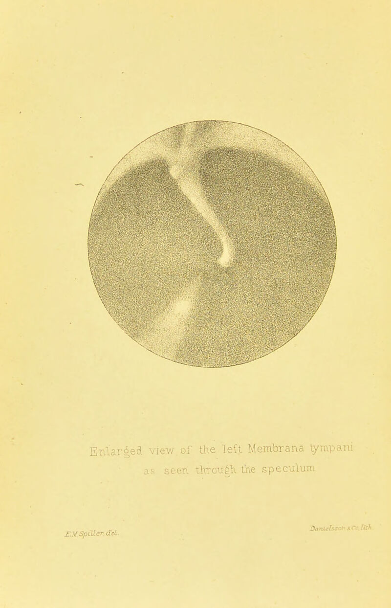 Enlarged view of the left Membrana tyiapani en through the speculum see S..VSpiUer.deL Danttrhson I Co, llti